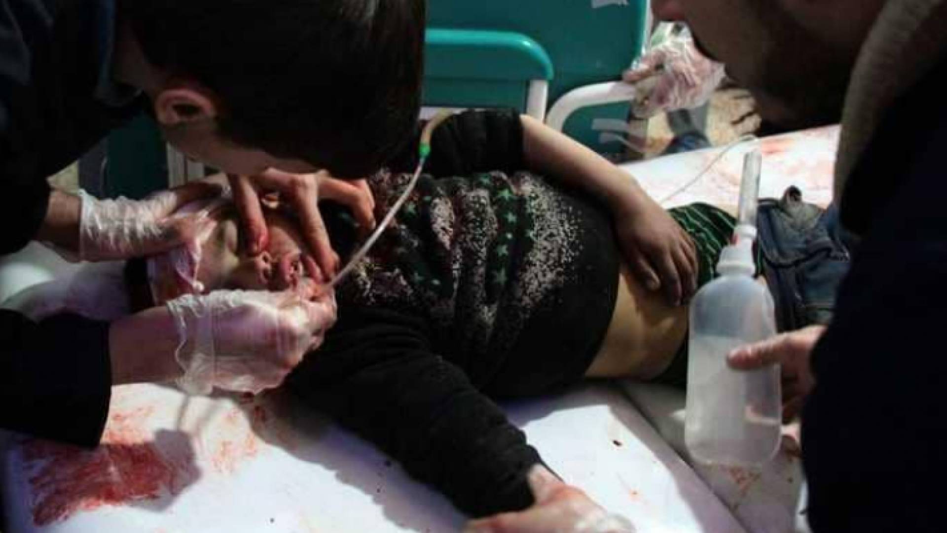 وفاة طفل جراء أعراض غاز الكلور- ارشيفية