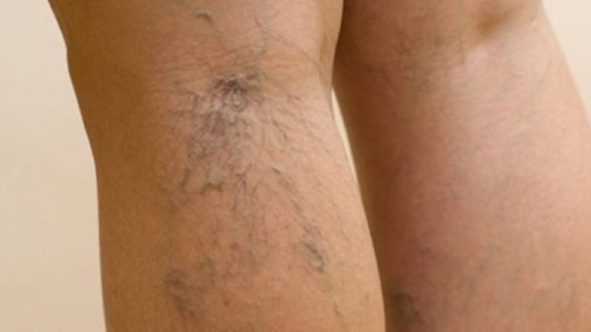 أوردة عنكبوتية بارزة بالقرب من سطح الجلد (أرشيف)