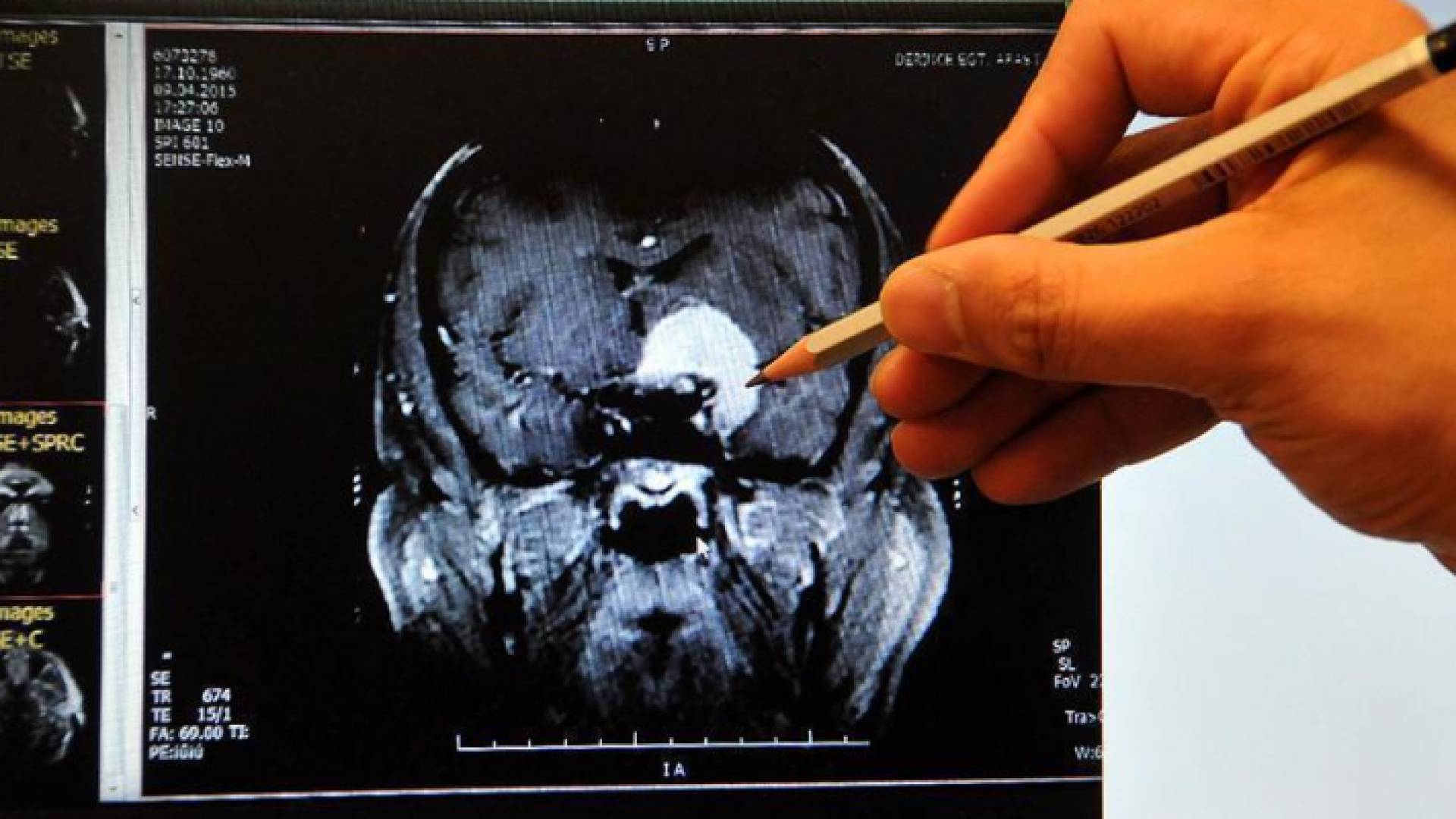 تقنية جديدة أقل تكلفة لقياس تدفق الدم في الدماغ