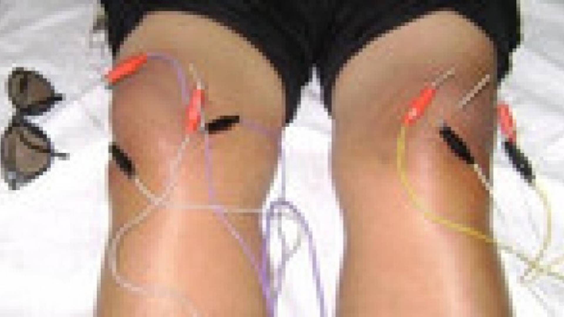 التحفيز الكهربائي.. أمل جديد للمصابين بشلل الركبتين