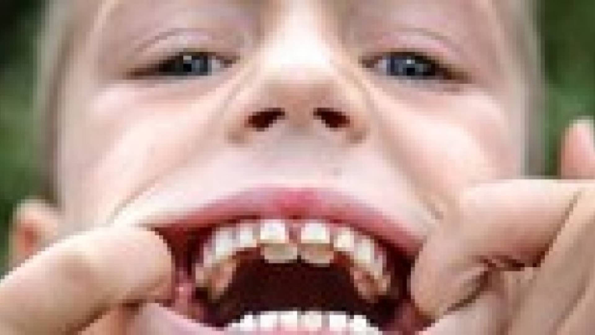 اطلاق لقب "الفك المفترس" على طفل بريطاني