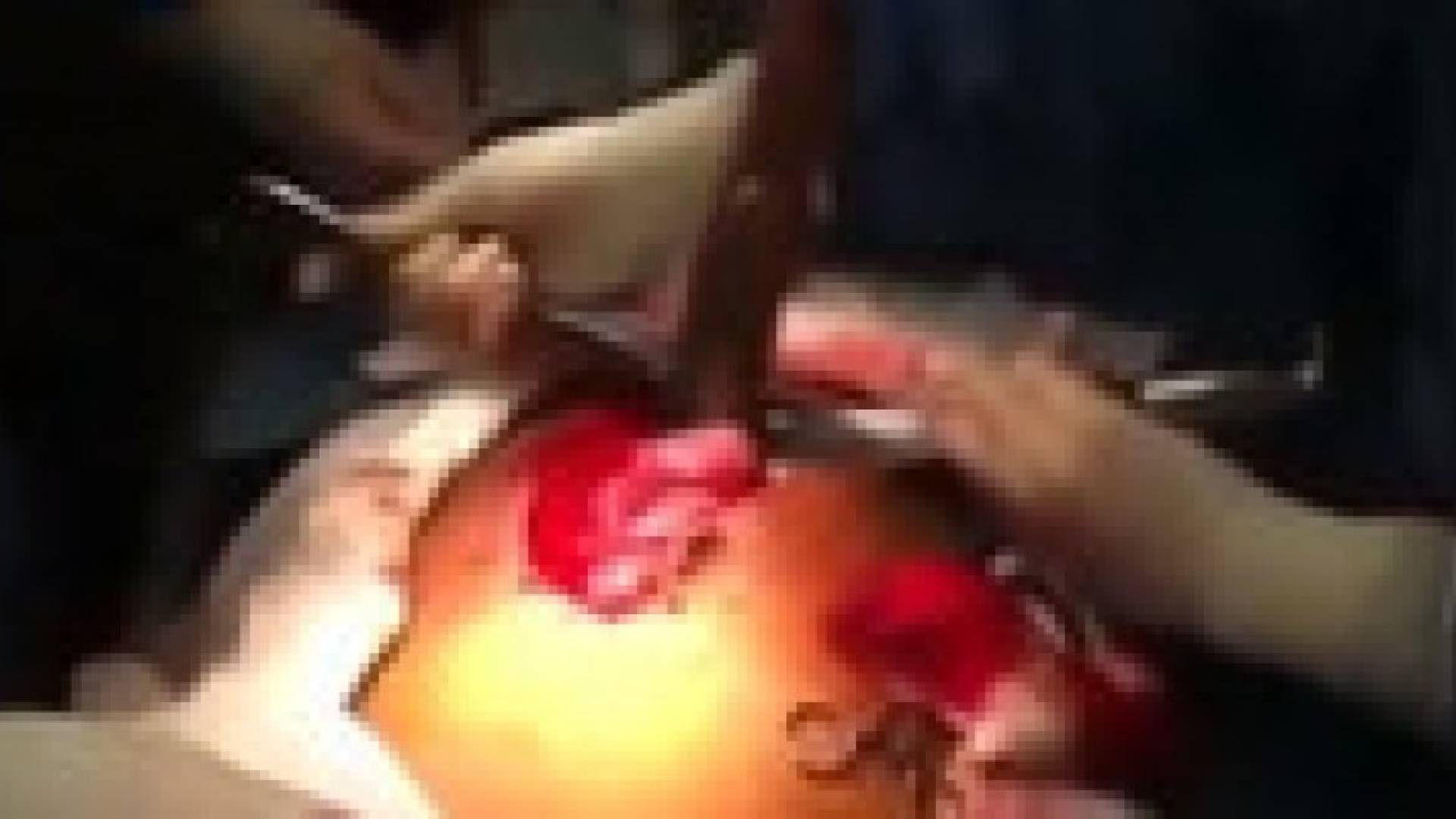 بالفيديو.. استخراج سمكة حية من أمعاء رجل برازيلي