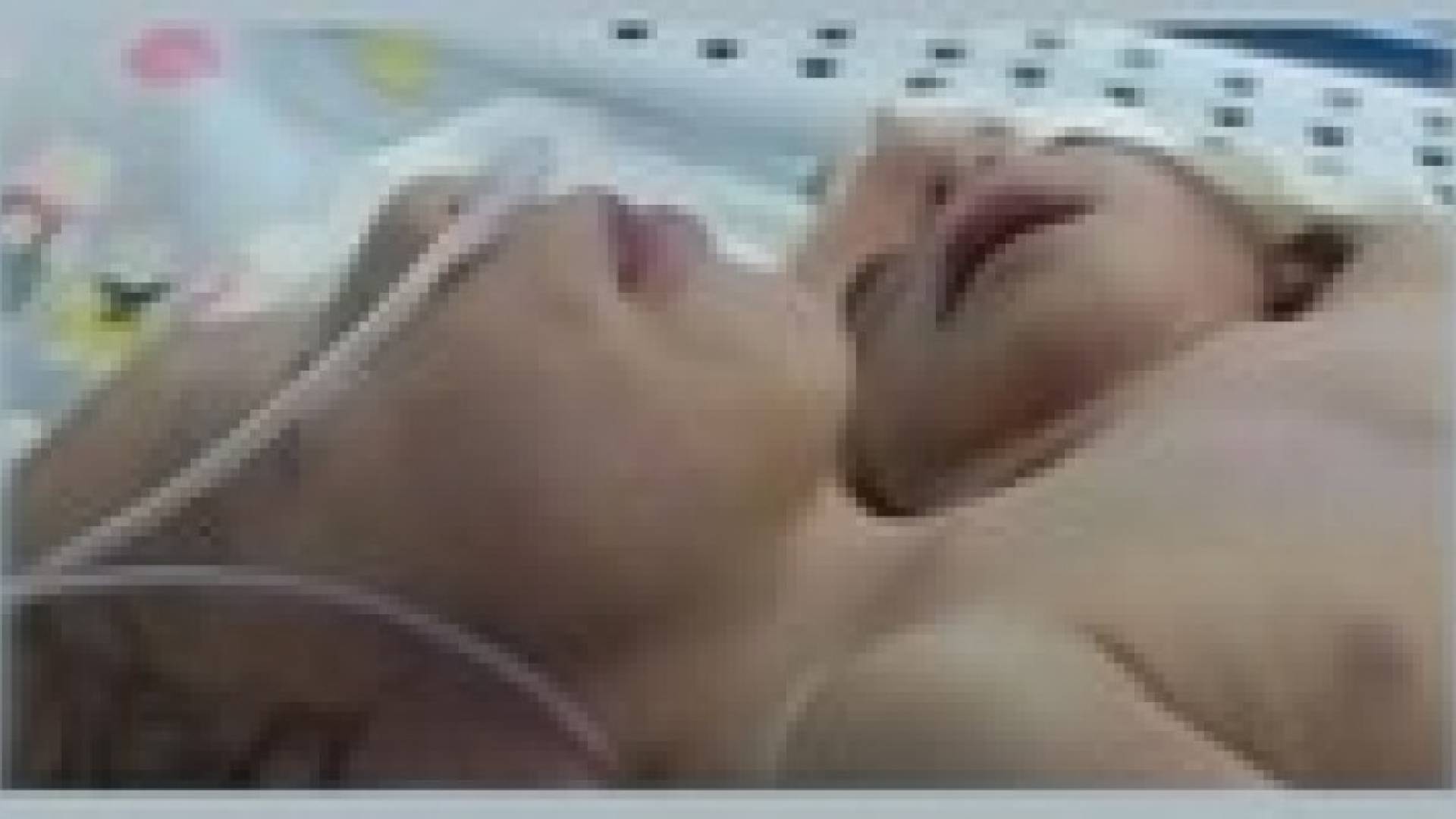 طفل مصري يولد في المنوفية برأسين وقلبين وثلاث أذرع