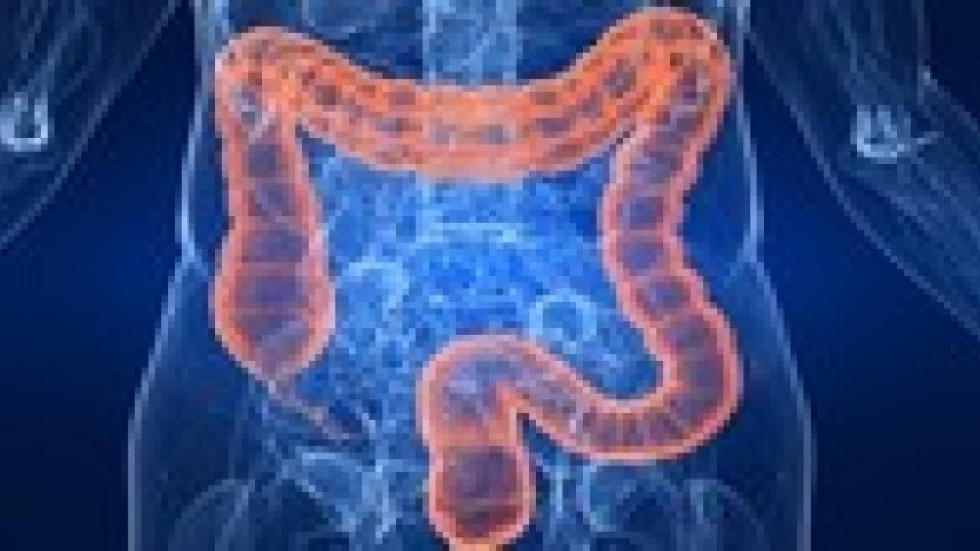 الغذاء غير الصحي يسبب انتشار سرطان الامعاء بين الشباب