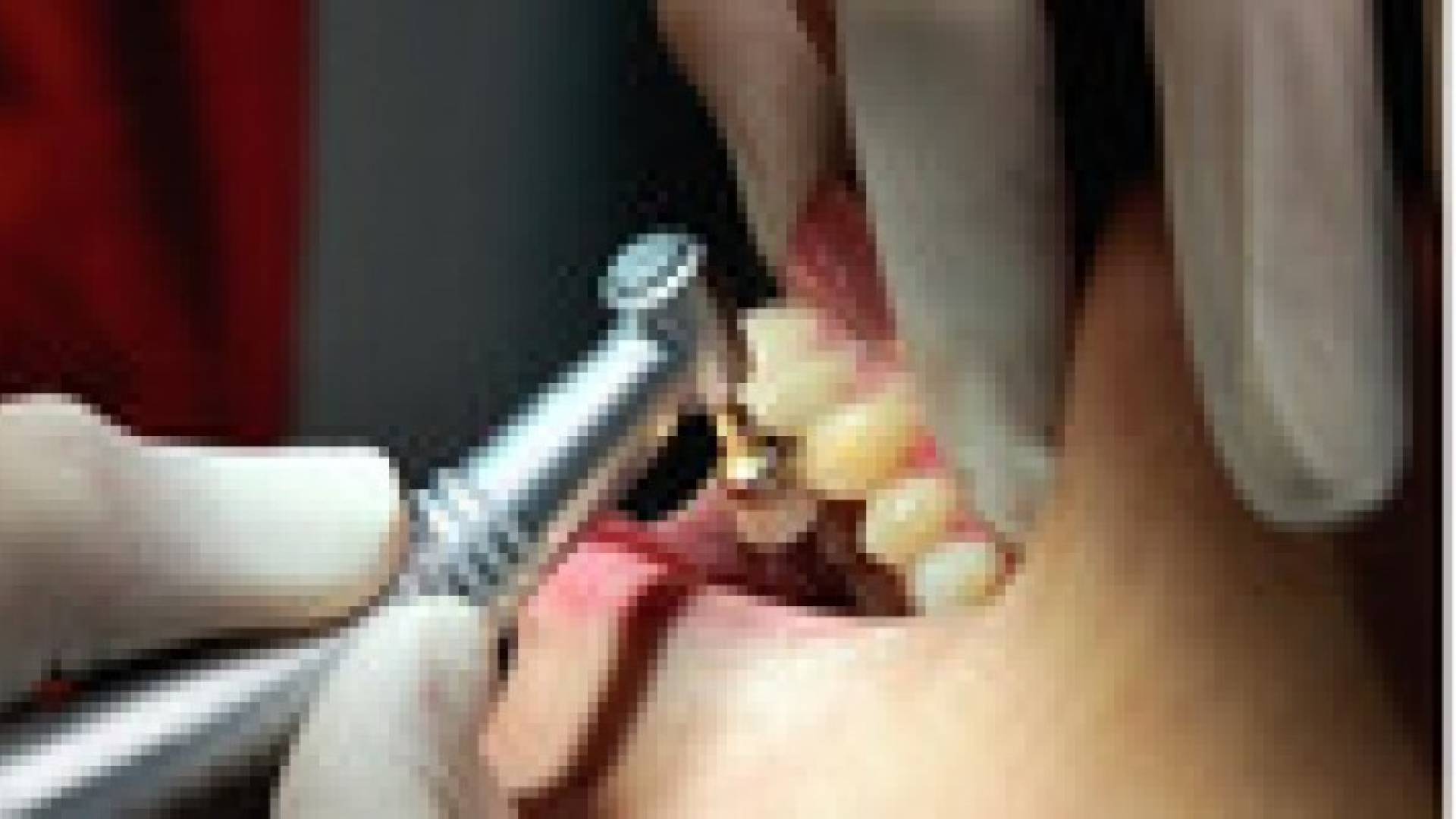 طبيب"ينقل" الإيدز لـ22 ألف مريض