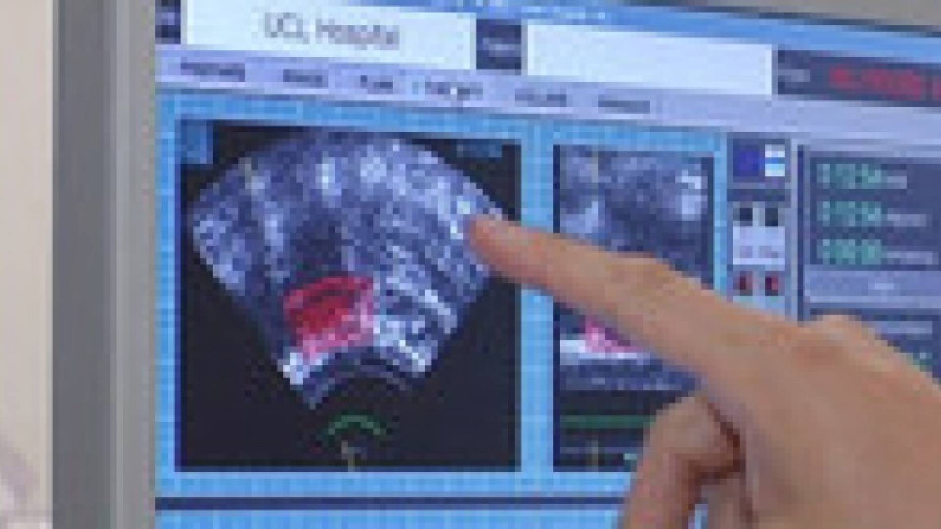 بريطانيا: اكتشاف طريقة جديدة لعلاج سرطان البروستات