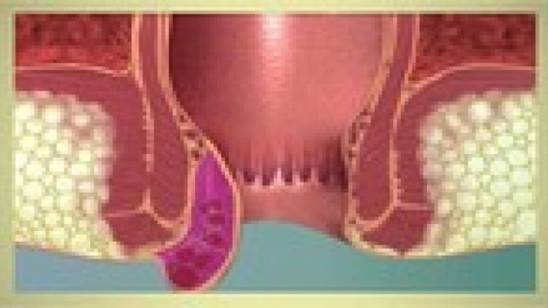 البواسير .. حلول جديدة