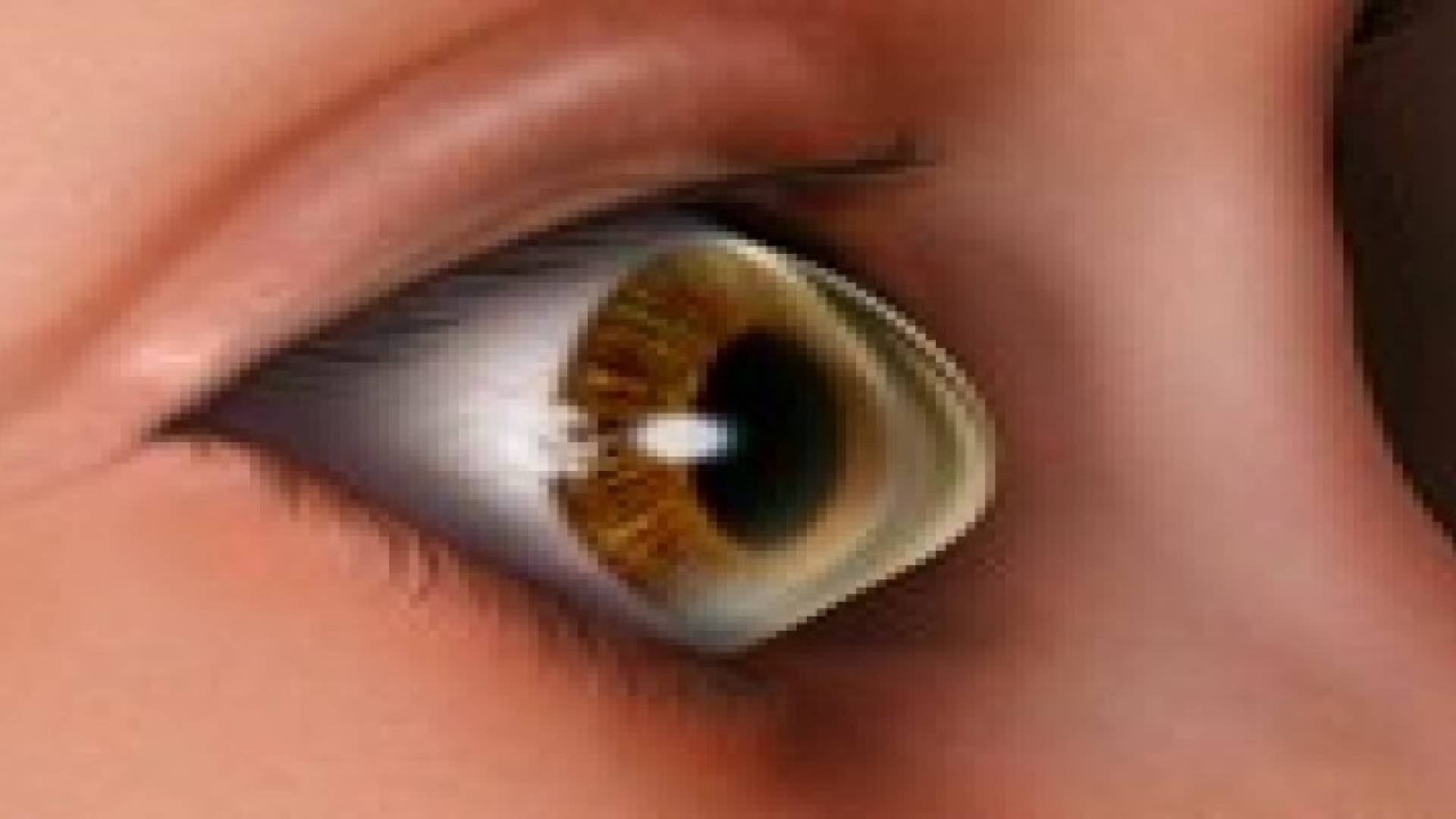 ما هي القرنية المخروطية ؟