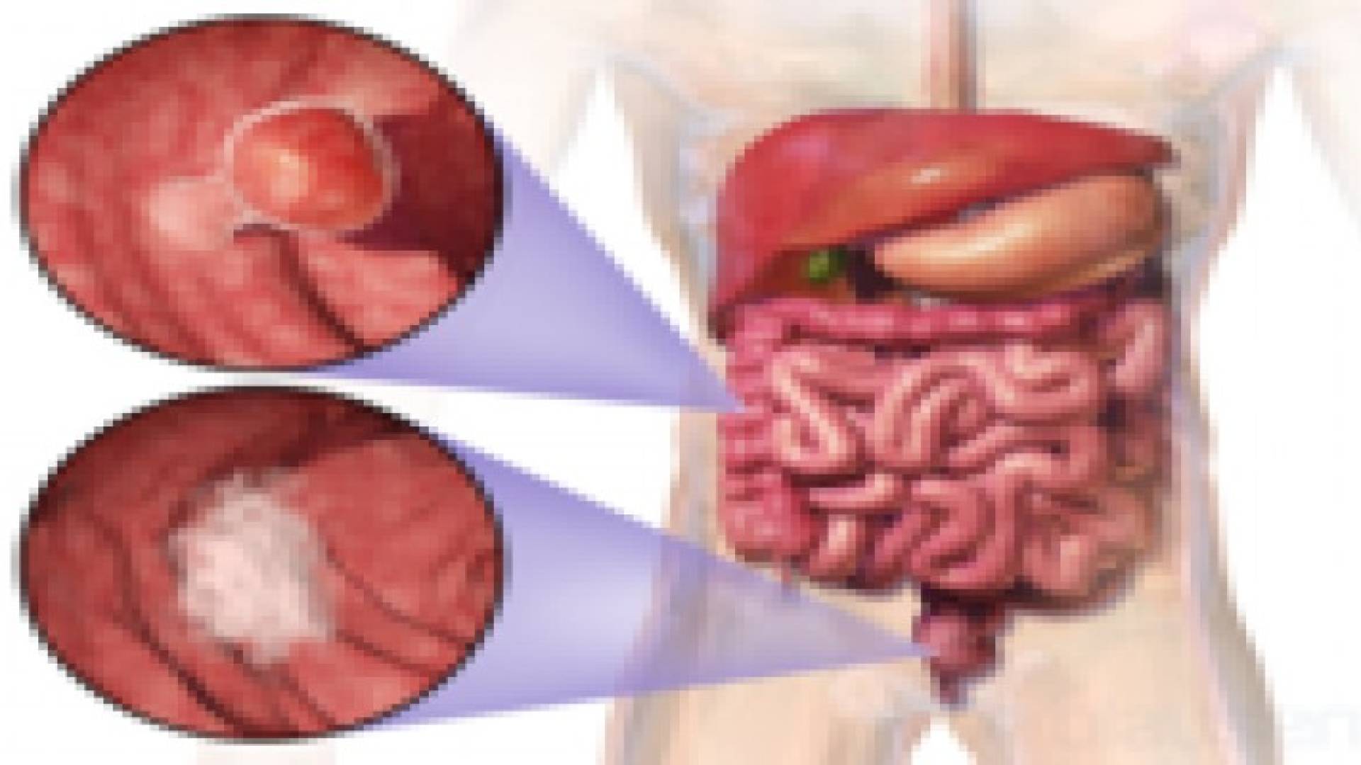 سرطان الامعاء يزيد بنسة 90% خلال 15 عام