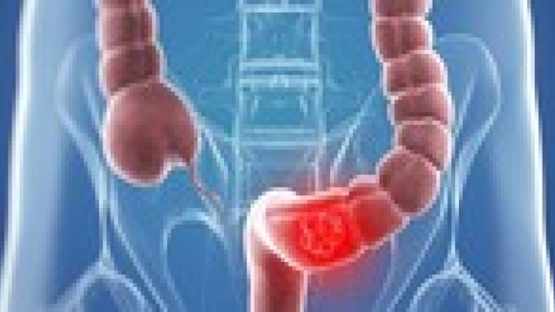 سرطان الأمعاء يزيد بنسبة 90% خلال 15 عاما