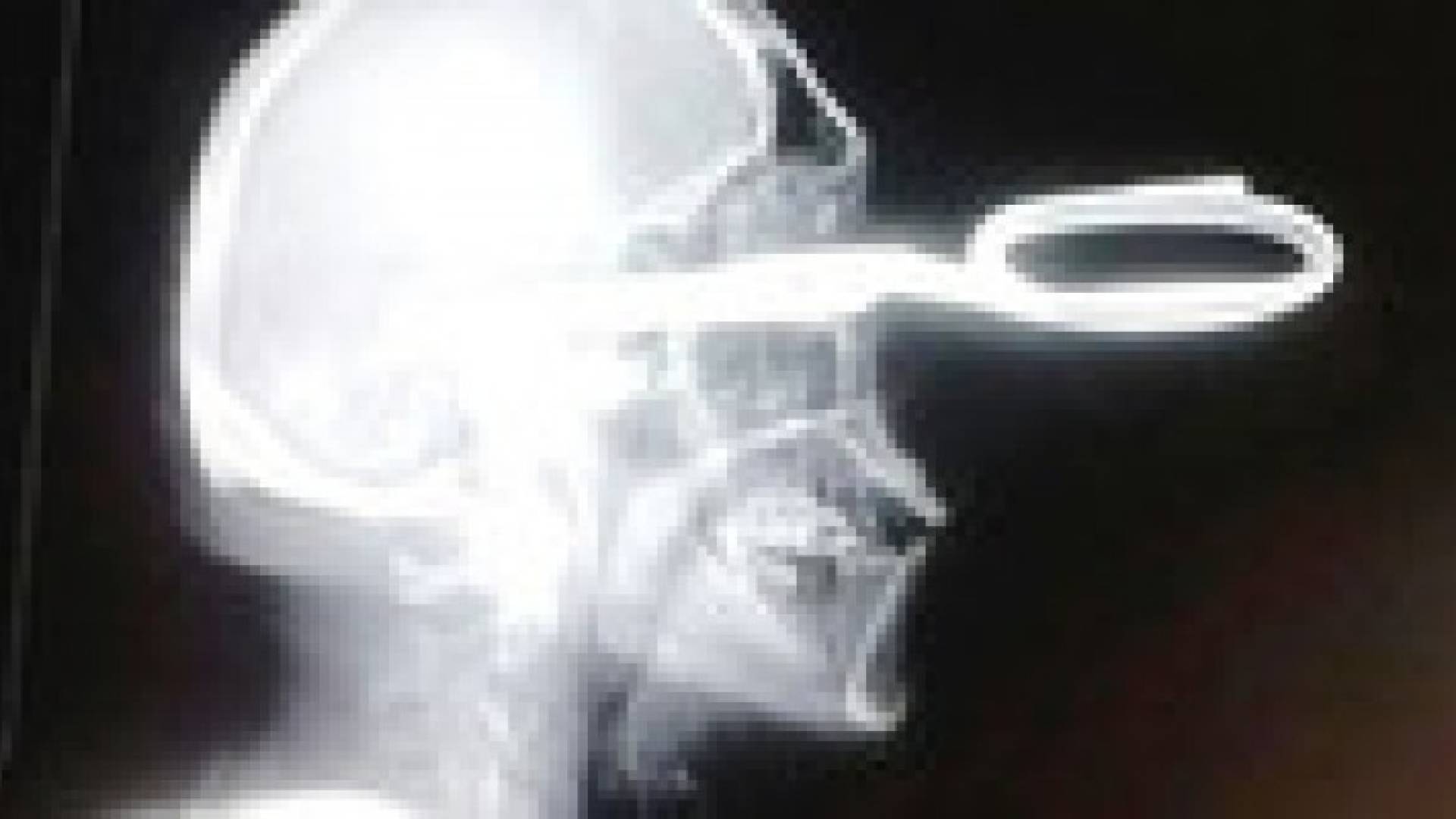 مكسيكي يزور مستشفى والمقص منغرز في رأسه