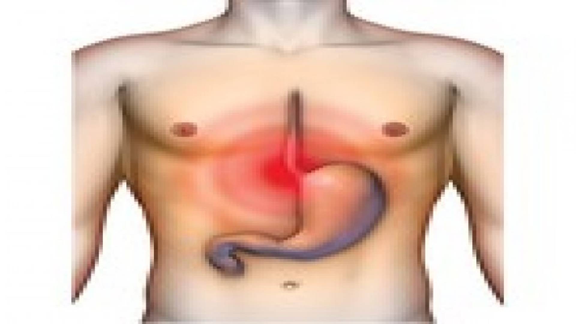 حرقة المعدة تتسبب في سرطان المريء