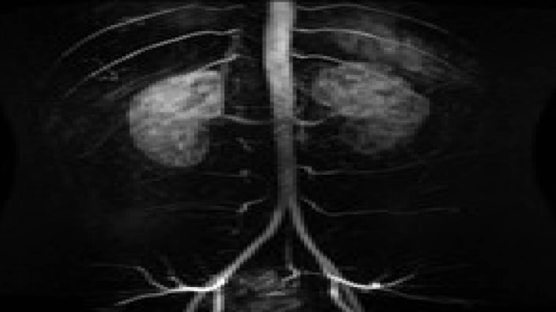 تقنية حديثة لعلاج تمدد الشرايين بلا تدخل جراحي