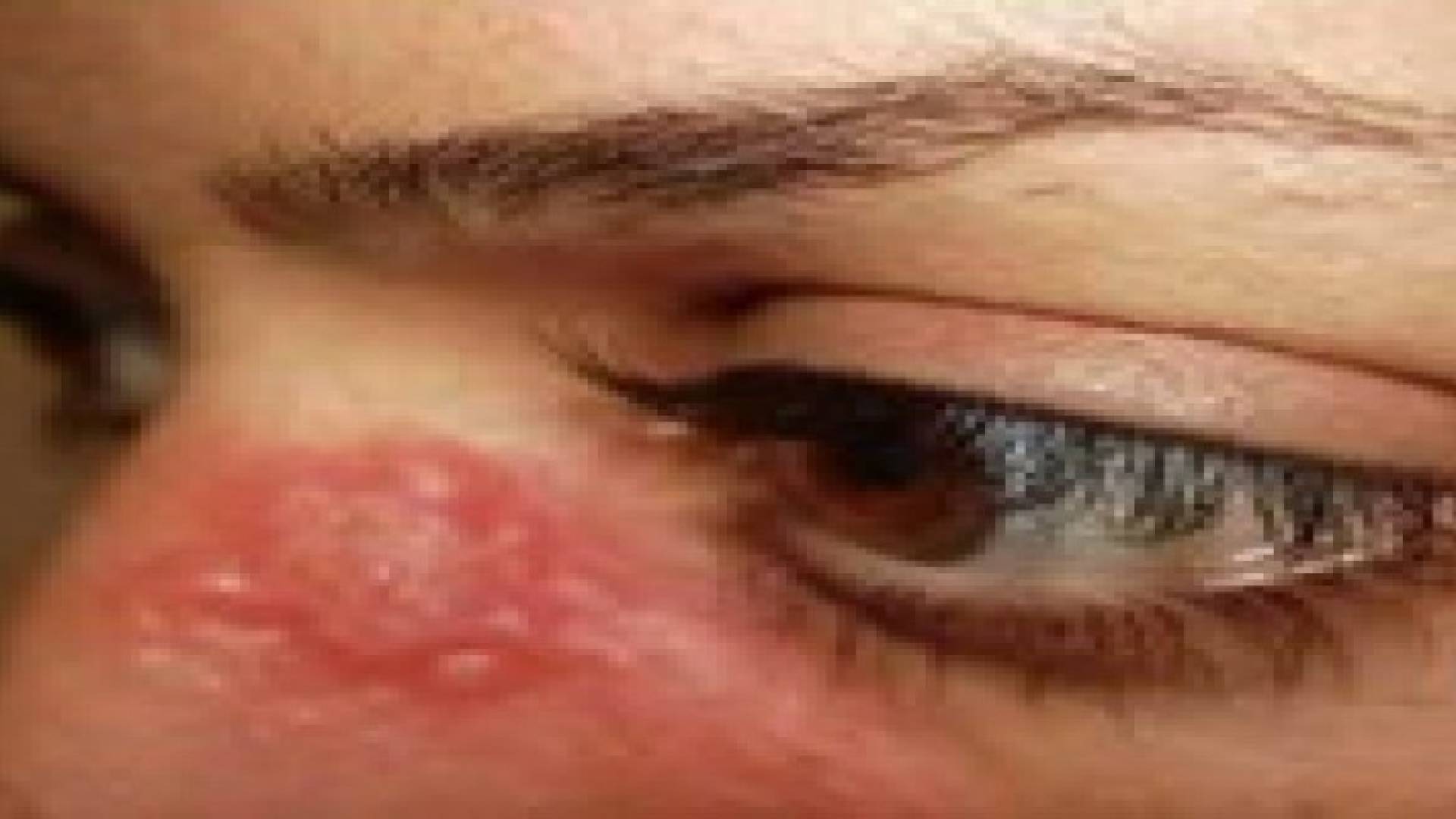 عشرات الإصابات بـ "الليشمانيا" في الضفة الغربية