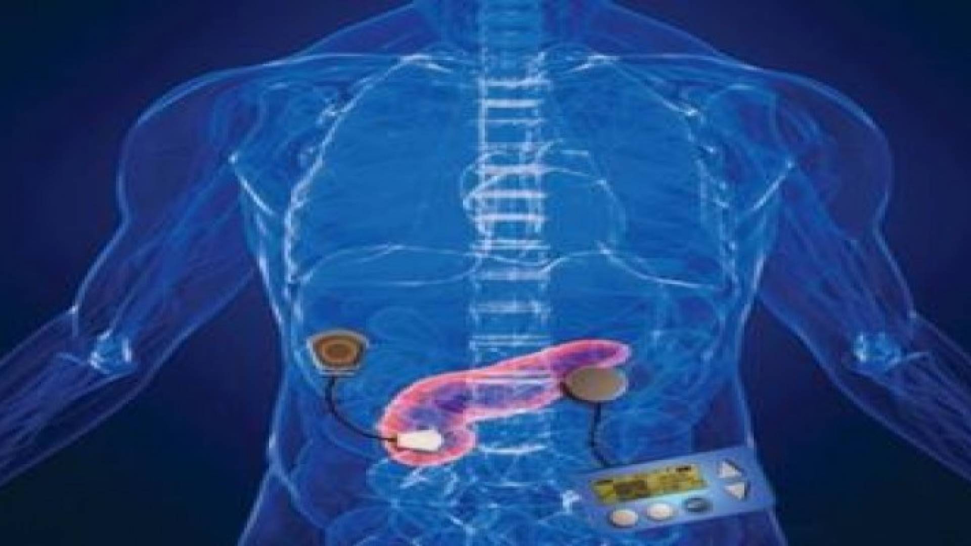 بنكرياس صناعي لمرضى السكري
