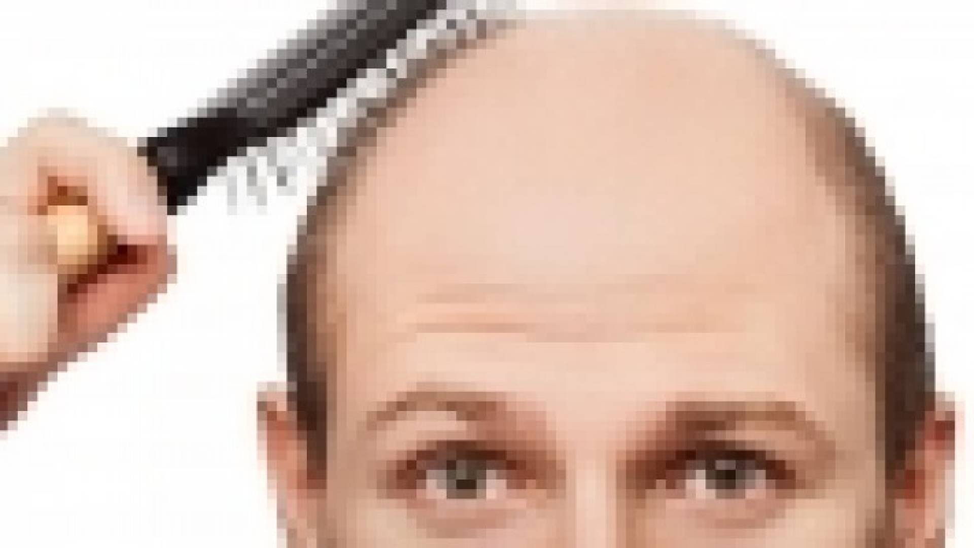 تقنية جديدة لزرع الشعر ومكافحة الصلع