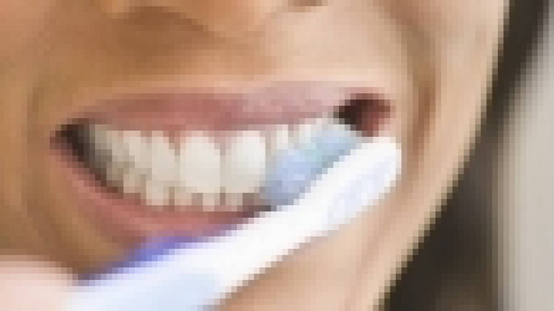 المبالغة بتنظيف الأسنان تضر بالمينا‬