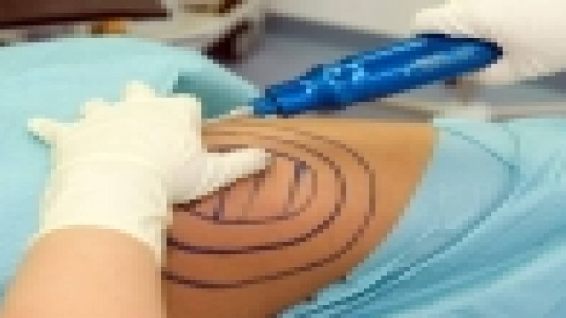 شفط الدهون.. آمال ومخاطر