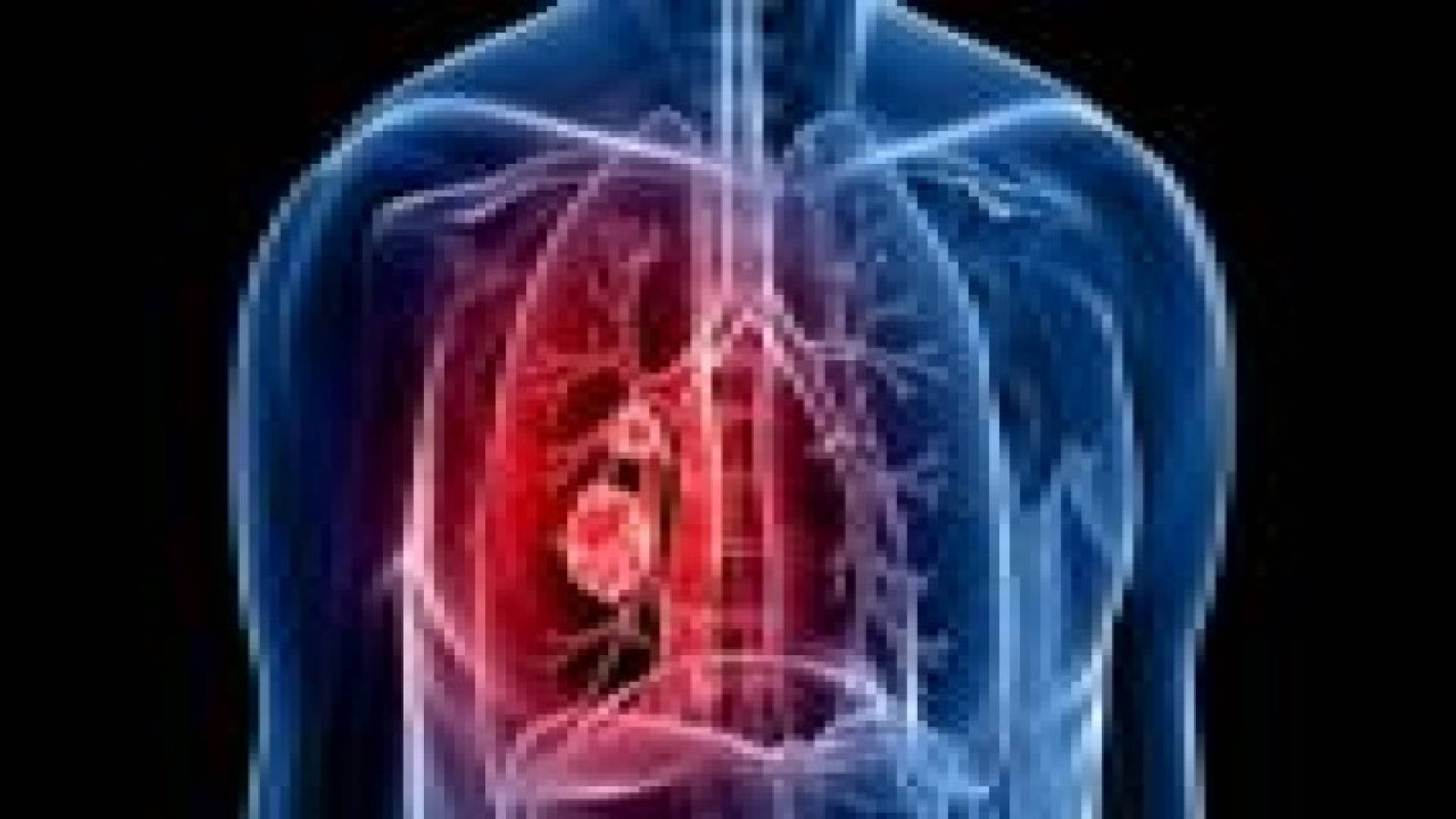 عقار لعلاج سرطان الرئة يؤخر تطور المرض أكثر من عام