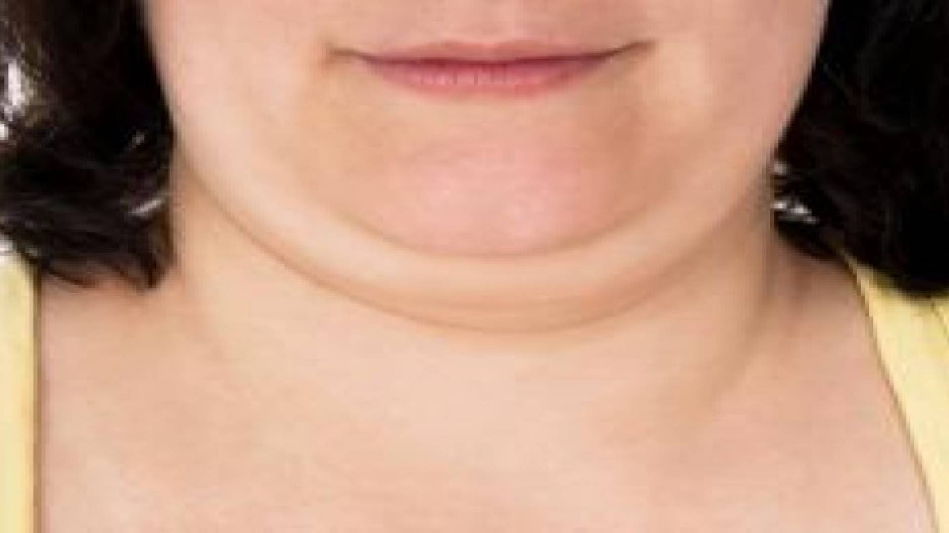 علاج جديد للذقن المزدوج