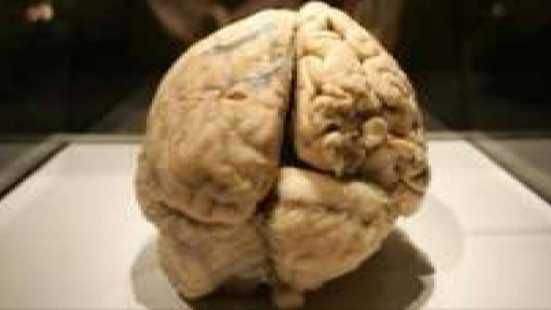 إزالة توأم من دماغ اختها بعملية جراحية في الهند