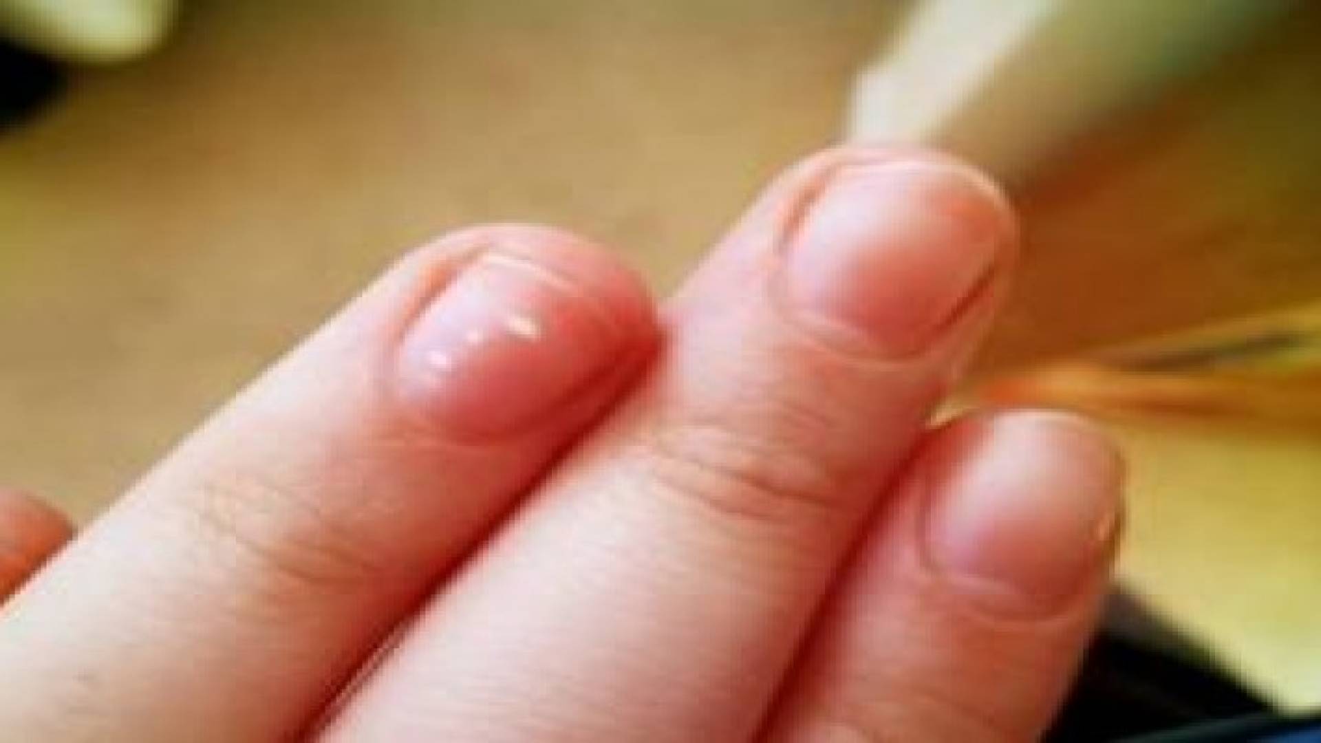 هل نقص الكالسيوم سبب بقع الأظافر البيضاء؟