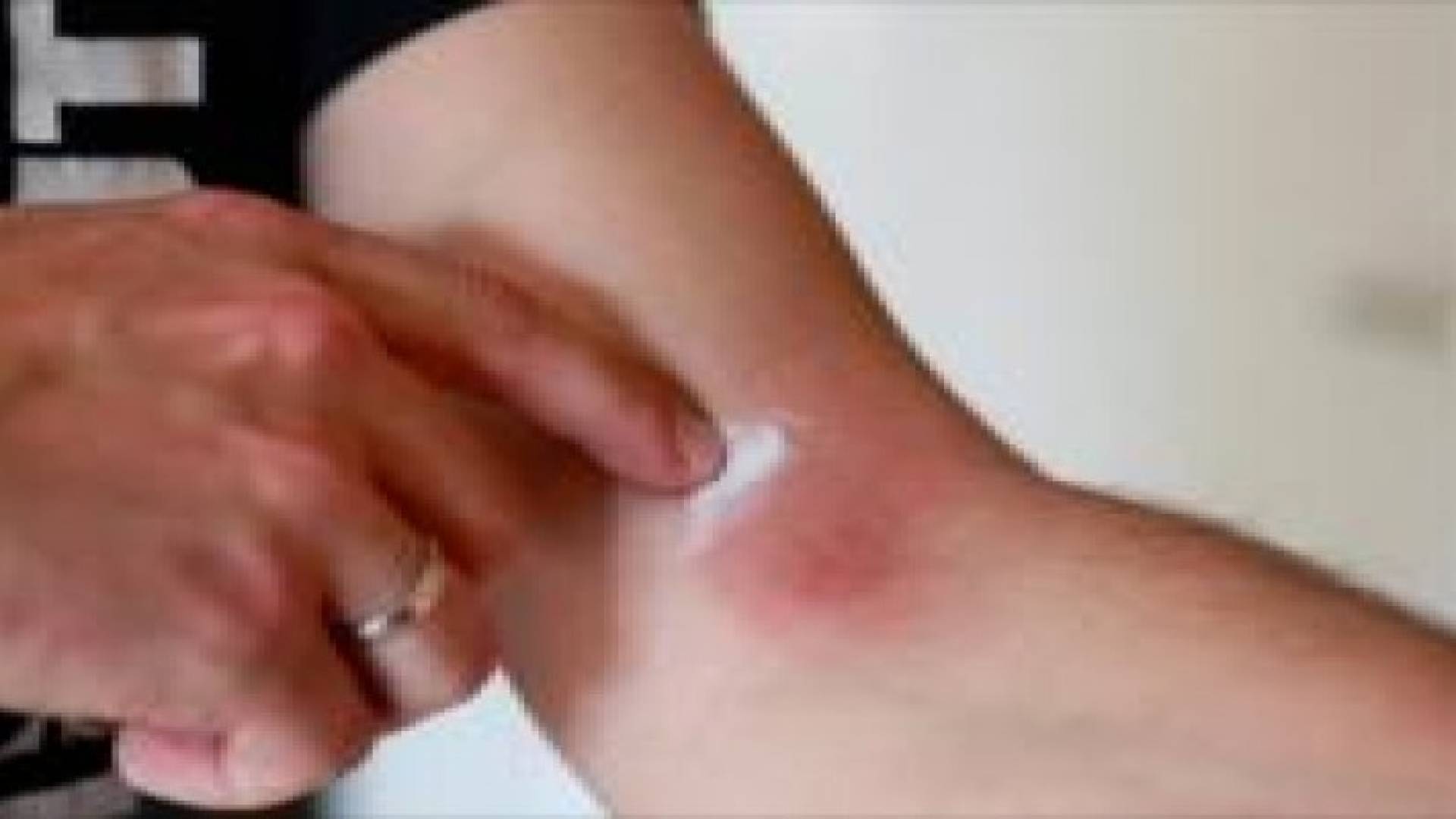 الصدفية.. أسبابها وطرق العلاج