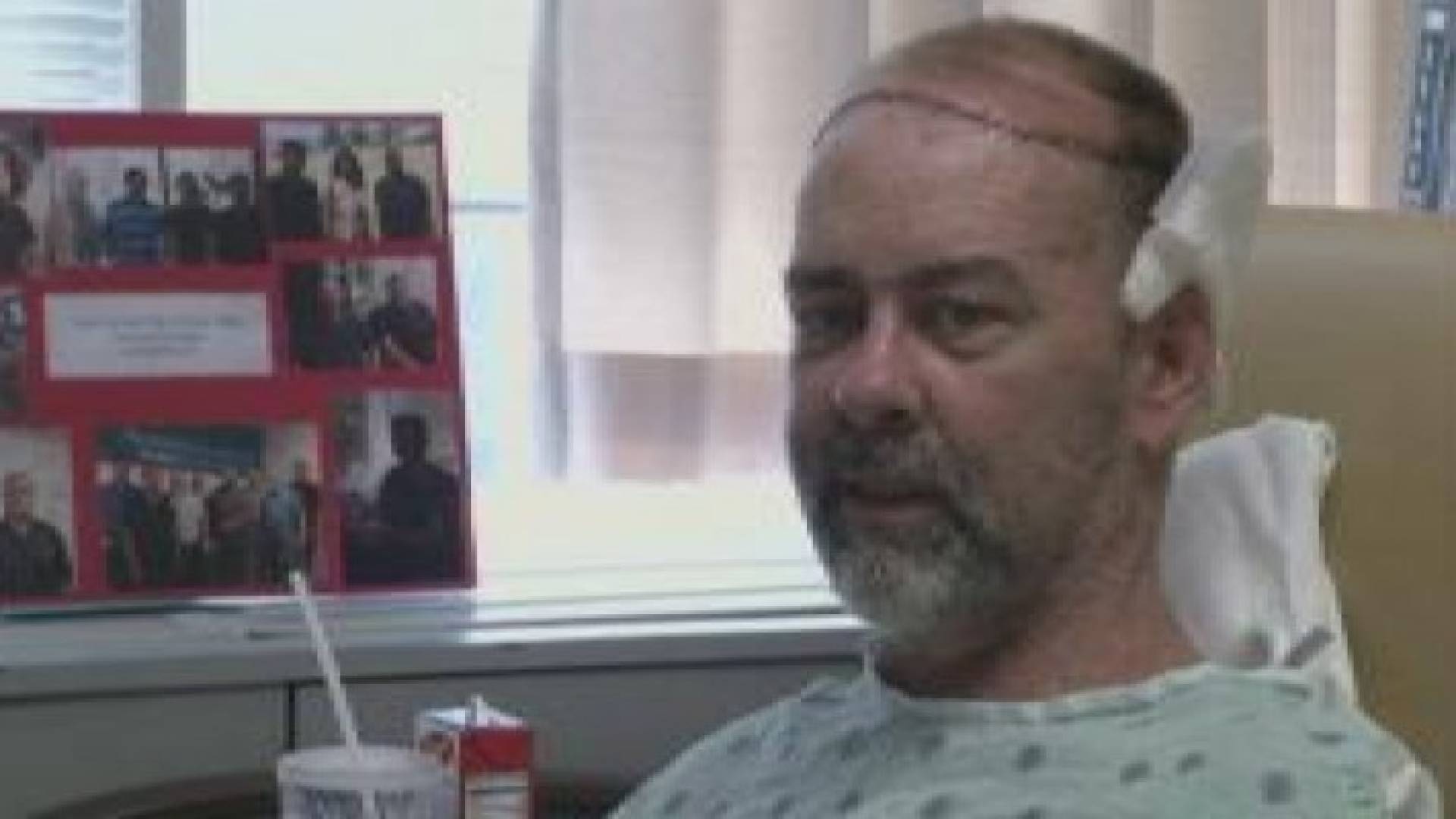 لأول مرة.. زراعة جمجمة وفروة رأس لمريض بالسرطان