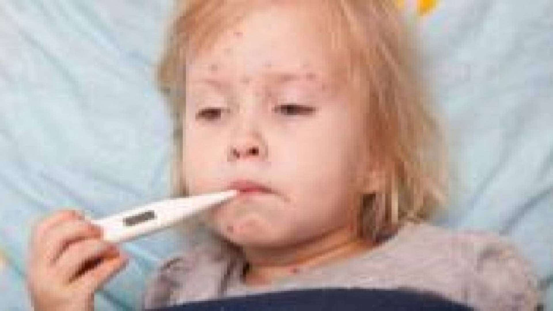 الحصبة تضعف مناعة الطفل