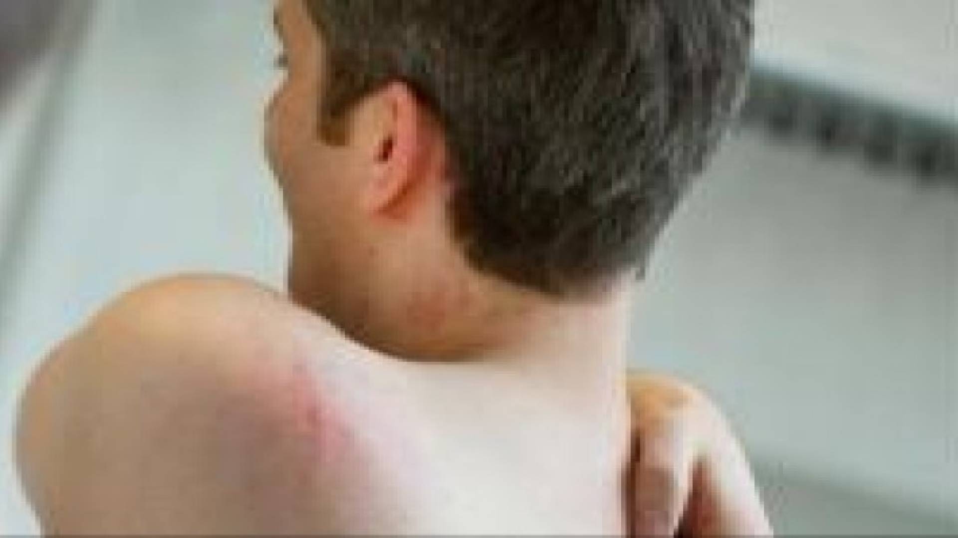 الطفح الجلدي الصيفي.. أسبابه والوقاية منه