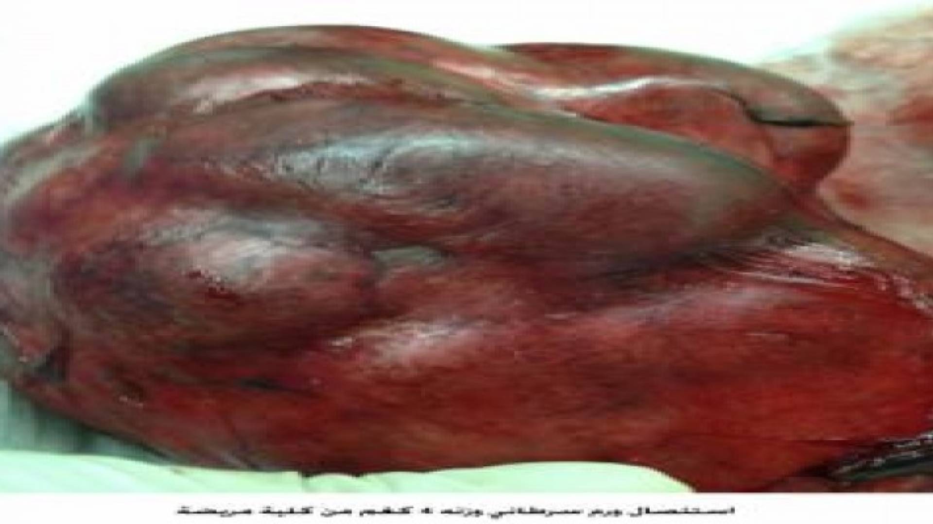 استئصال ورم سرطاني وزنه 4 كغم من كلية مريضة