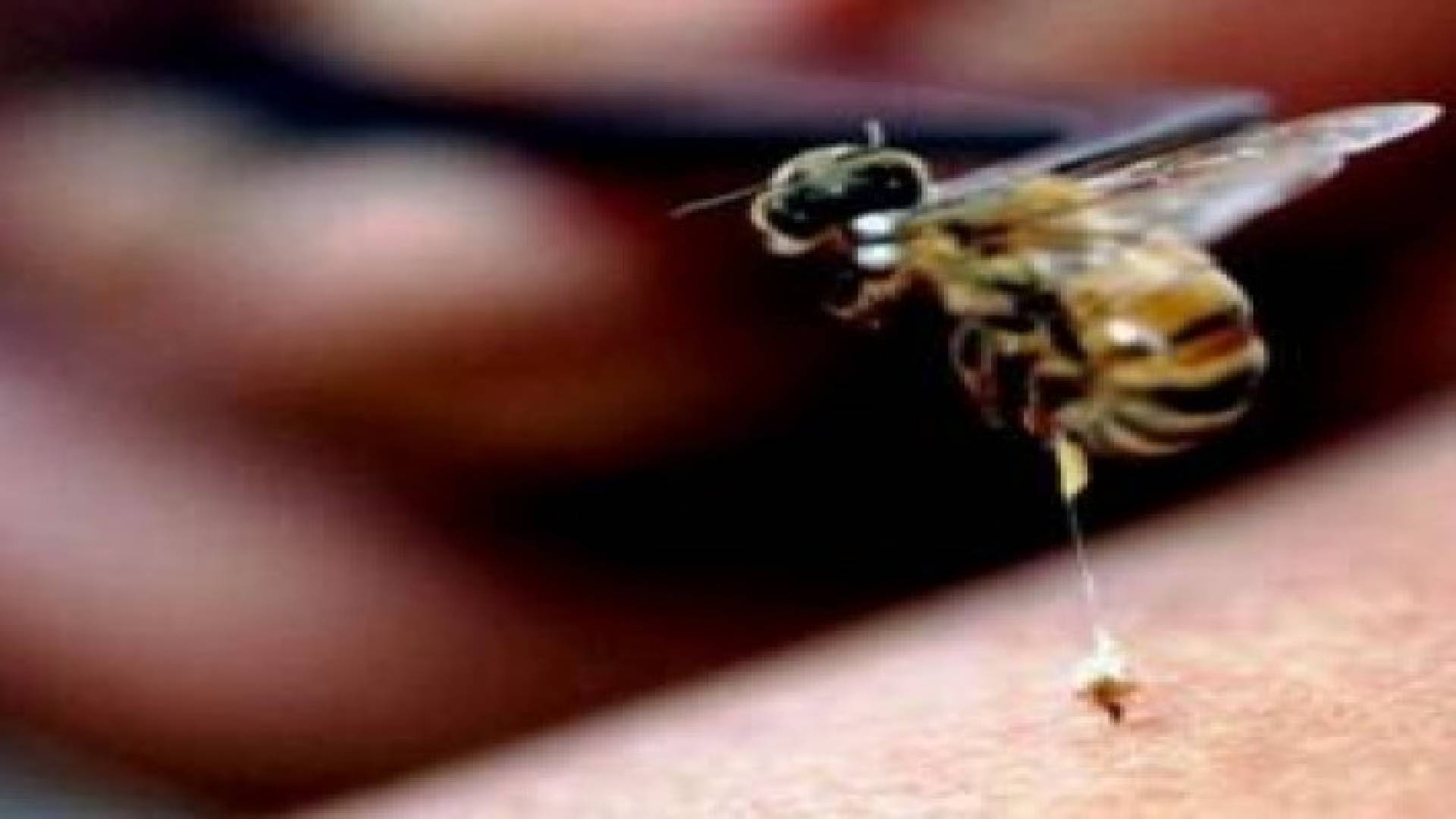 متى تشكل لدغات الحشرات حالات طوارئ؟