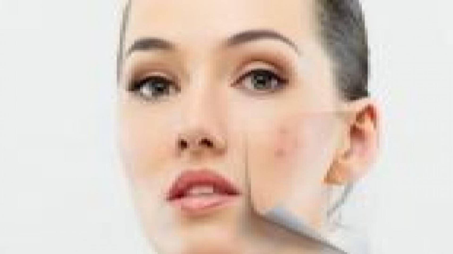 حب الشباب يزيد خطر سرطان الجلد