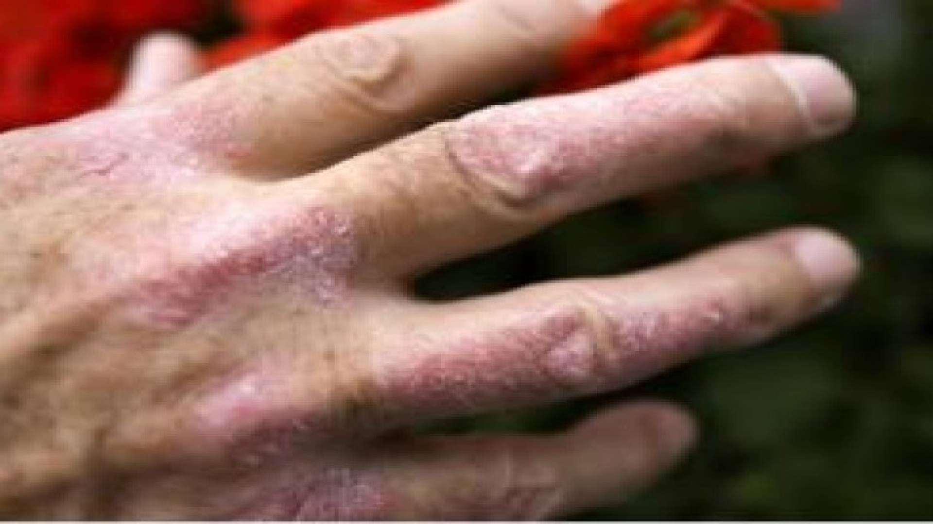 الروماتيزم غالبا ما يترافق مع الصدفية‬