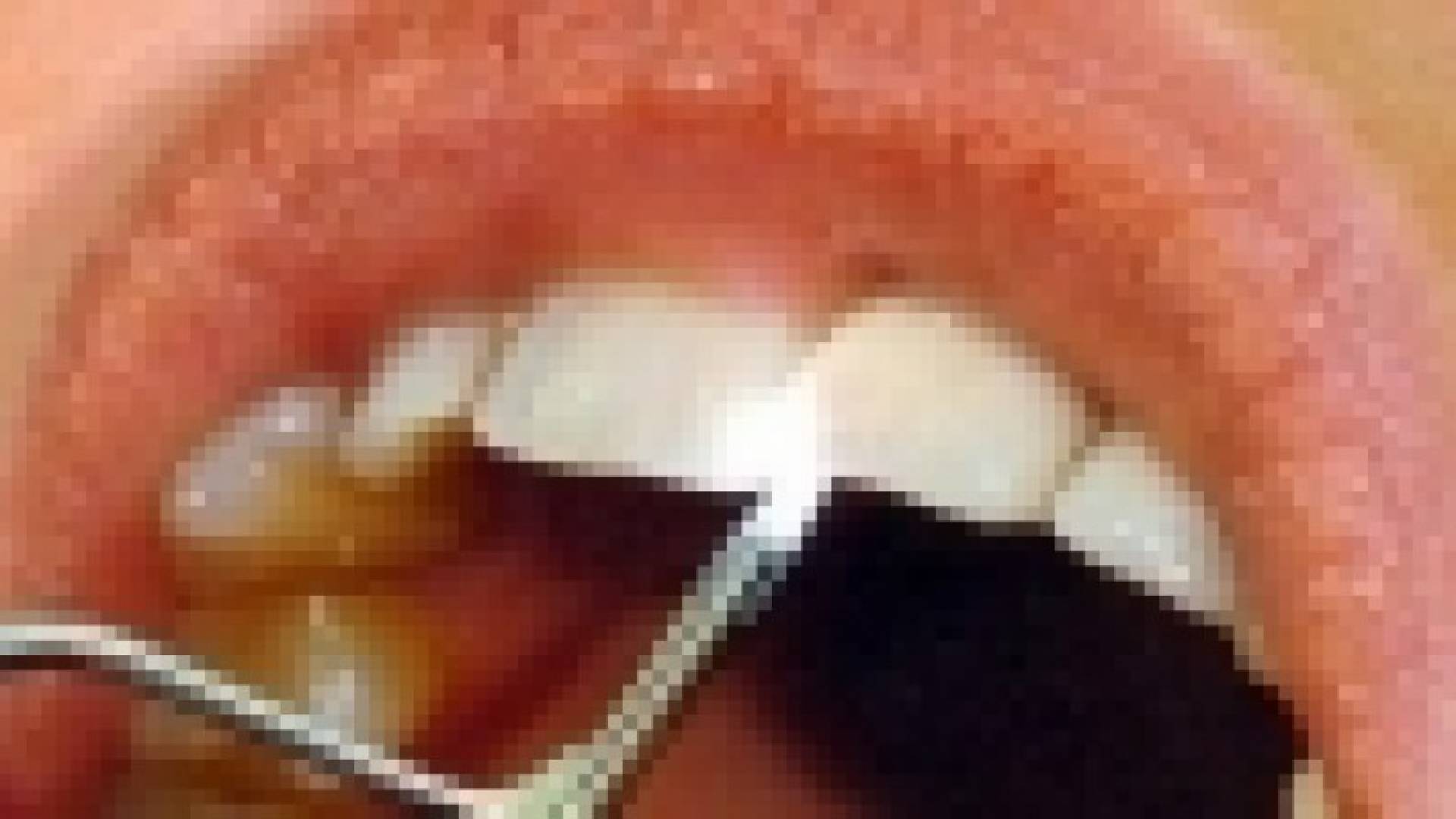 نزف اللثة قد يشير لالتهاب دواعم السن