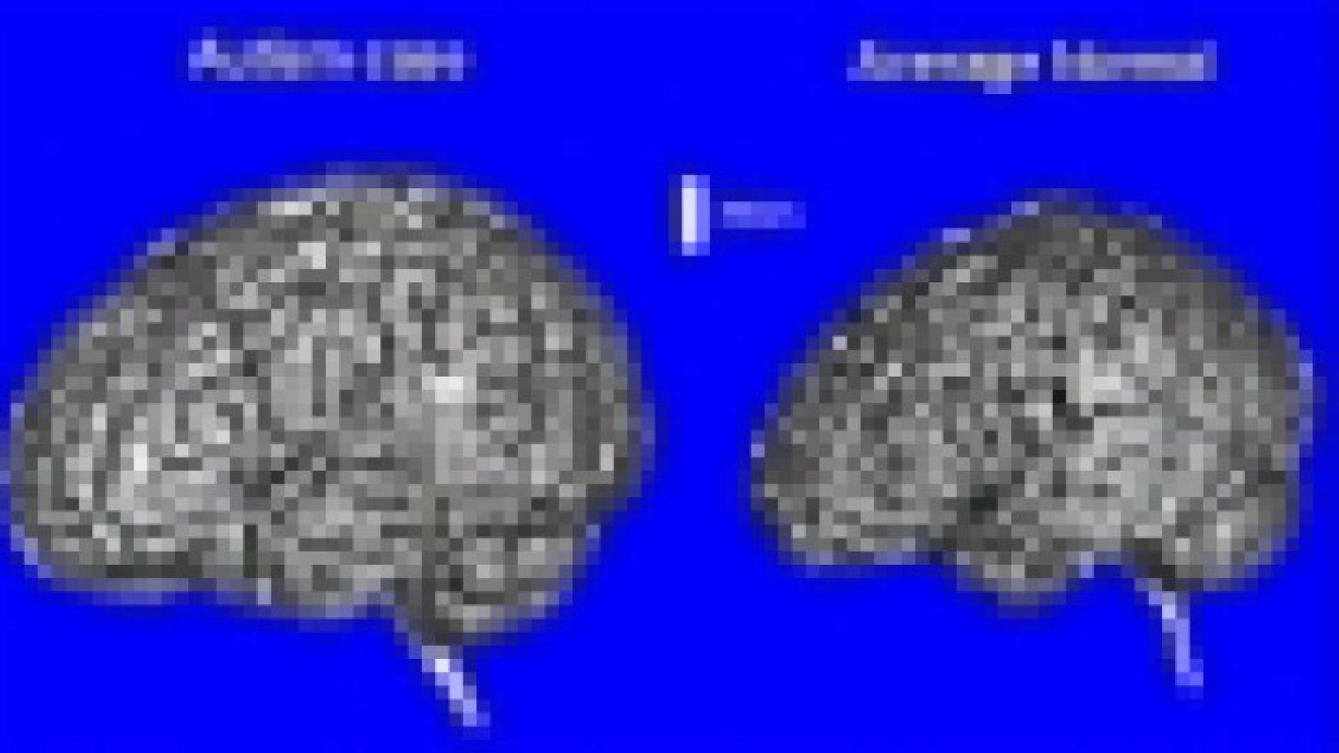 مريض التوحد خلاياه أكثر ودماغه أكبر