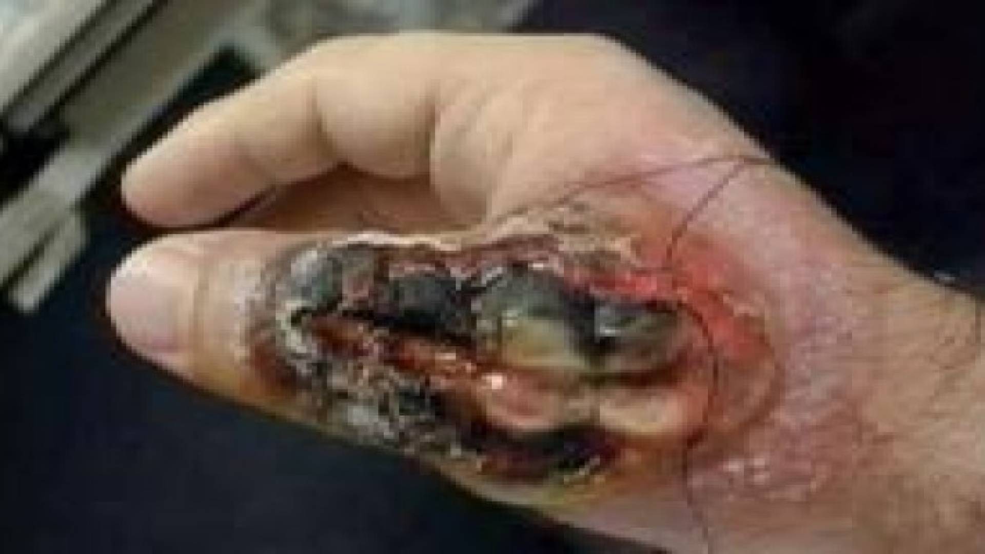 أخطر 10 حشرات في العالم ..فيديو