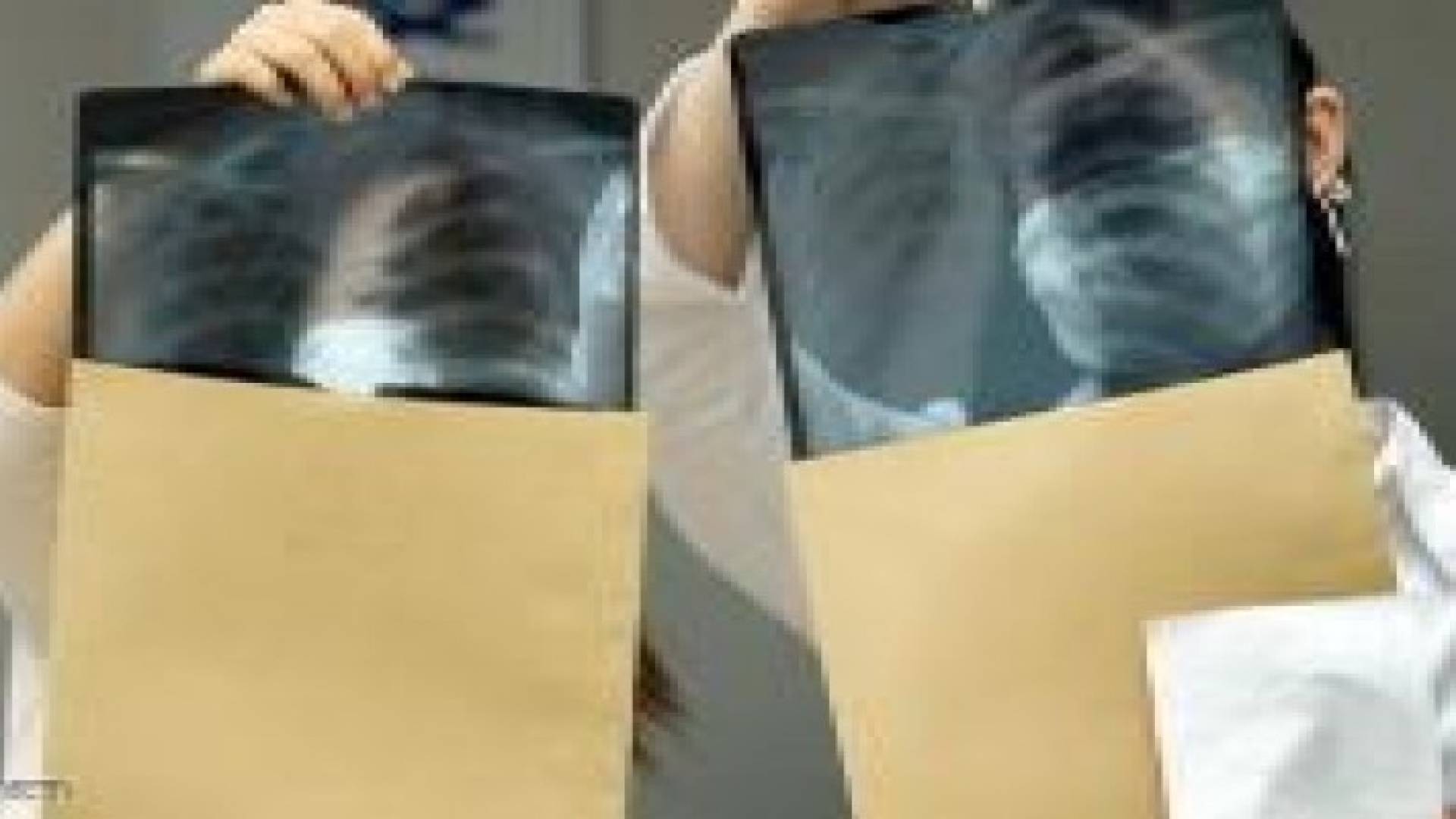إسبانيا : أول عملية لزرع قفص صدري "مطبوع"