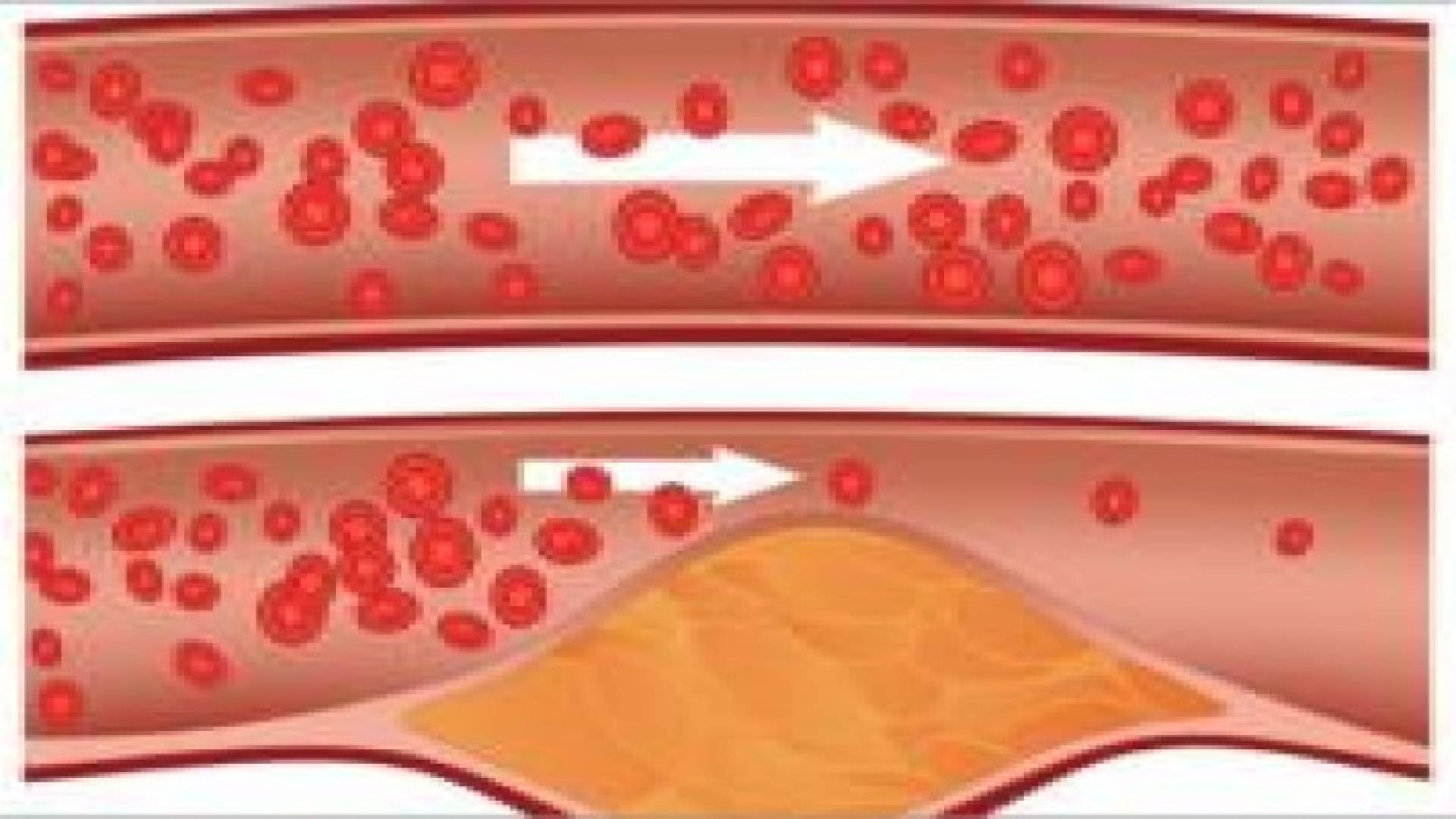 الفحص المنتظم للكوليسترول يجنبك تصلب الشرايين‬