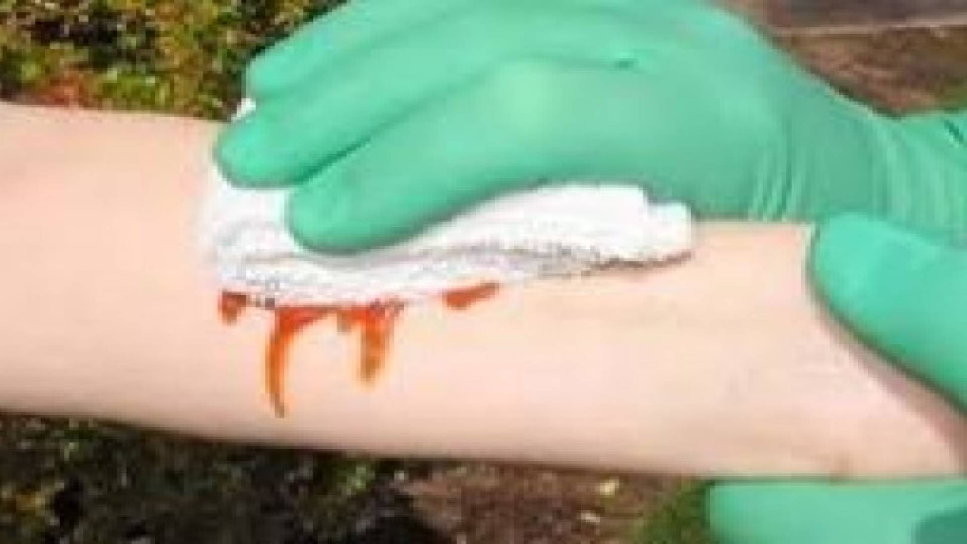 تطوير مسحوق قادر على وقف النزيف فورا