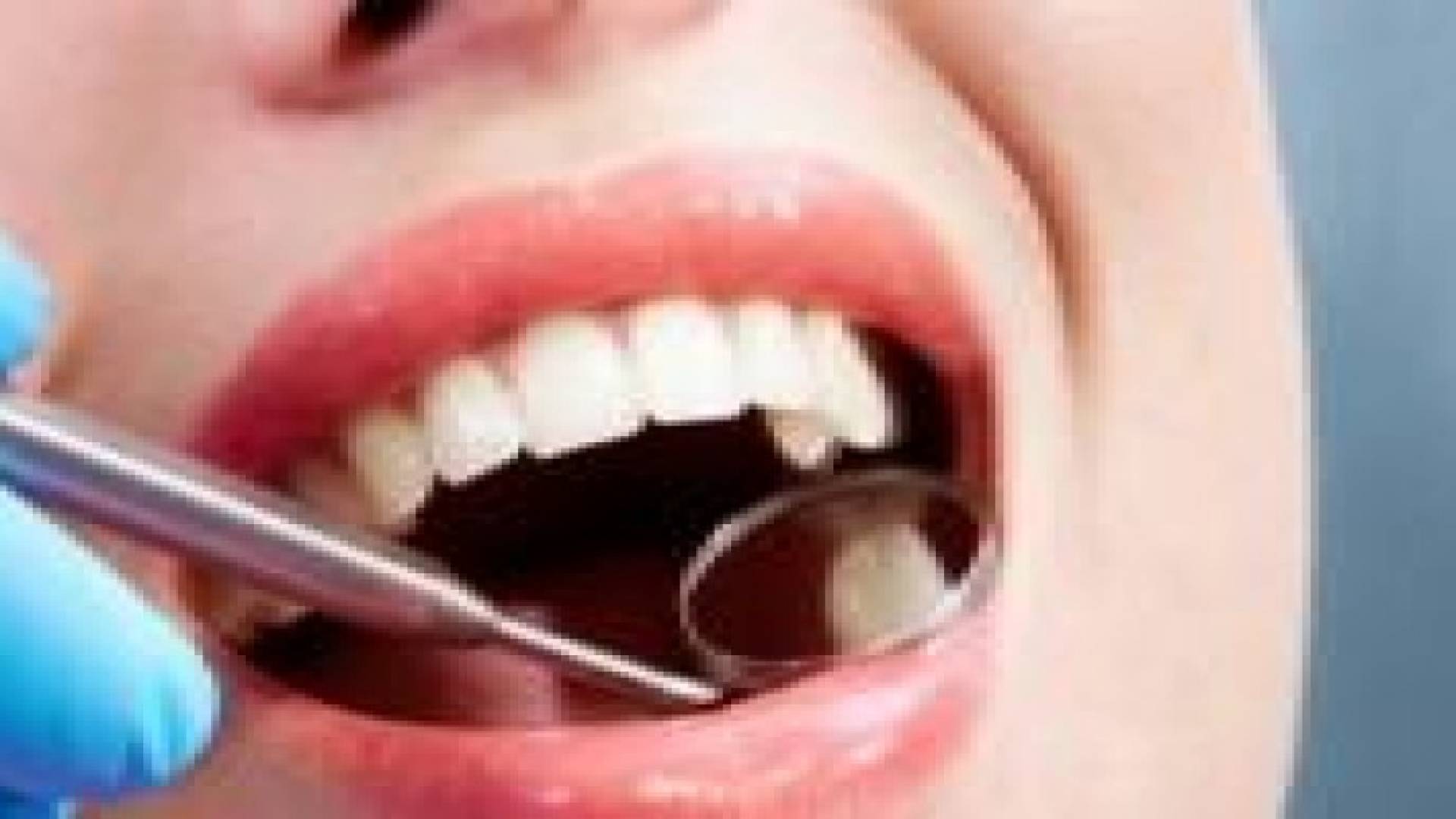 حشو السن بطريقة خاطئة قد يؤذي السليمة المجاورة