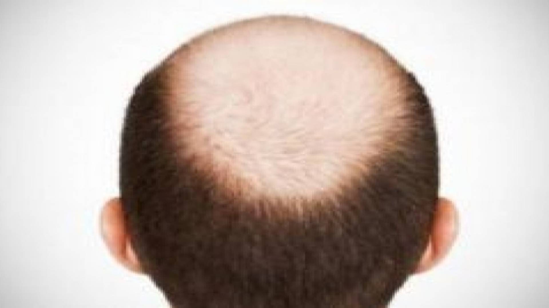 دراسة جديدة تحمل أملا للصلع