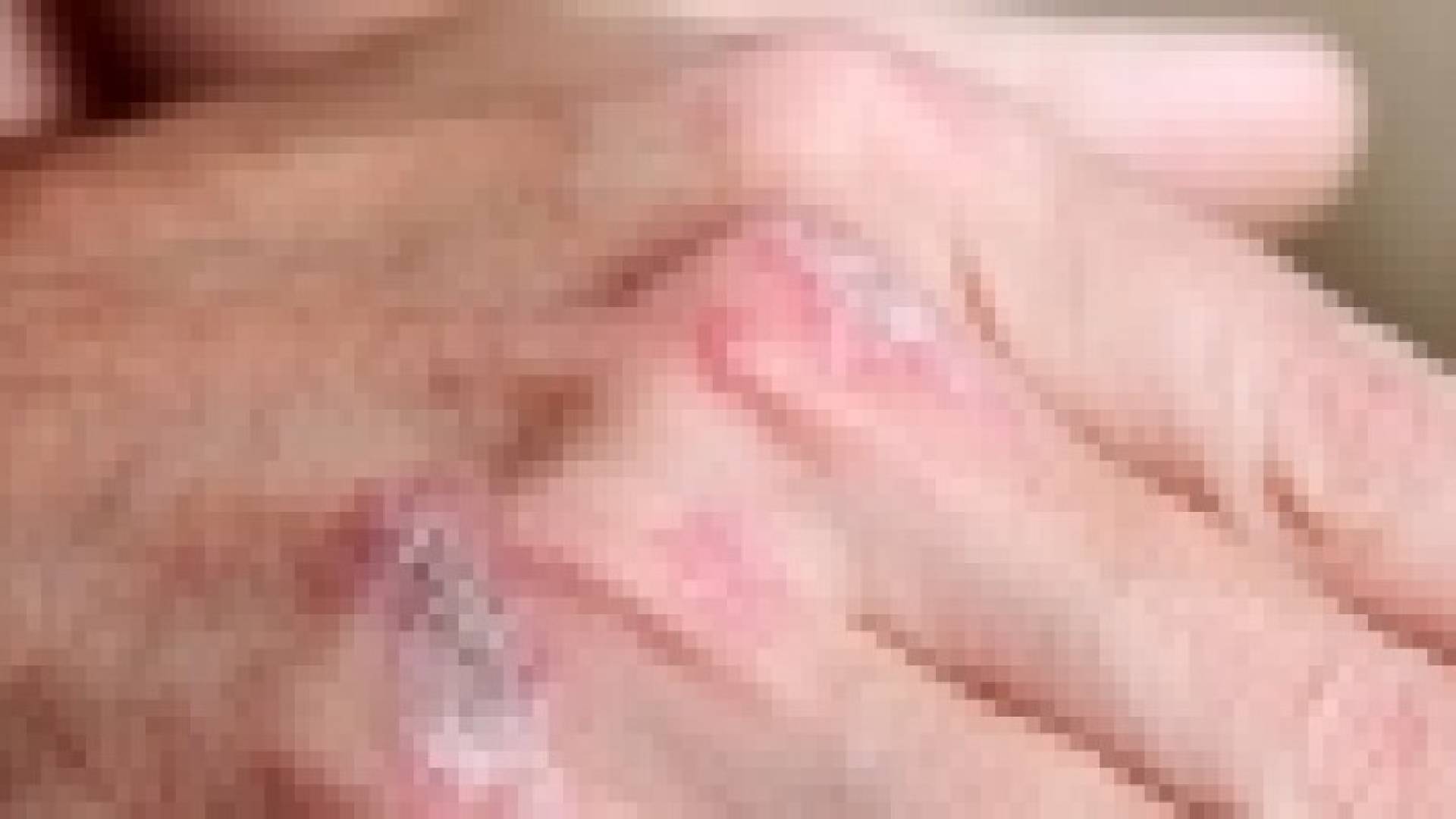 الصدفية في يومها العالمي