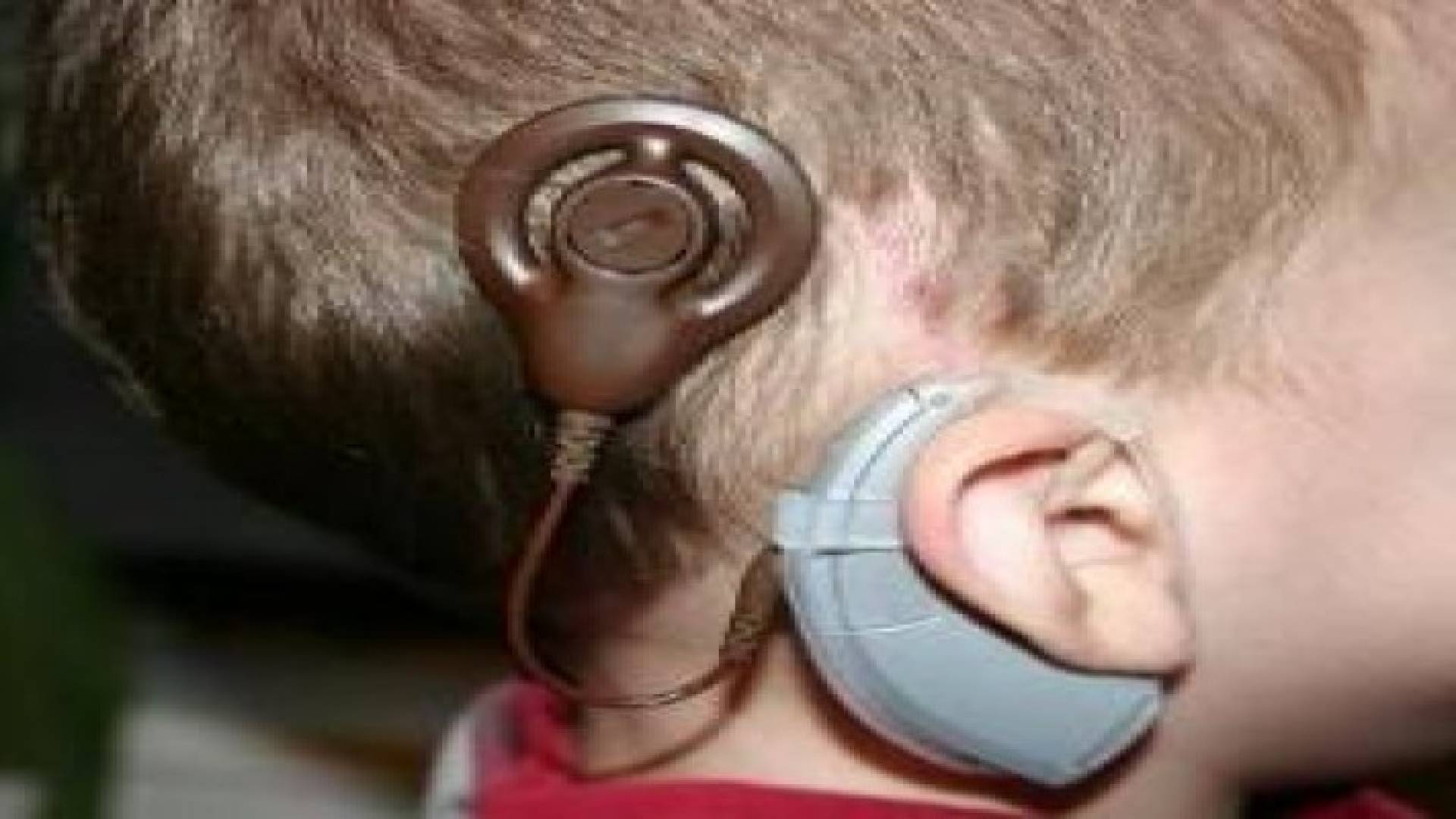 تواصل عمليات زراعة القواقع السمعية ضمن مبادرة ولي العهد "سمع بلا حدود"