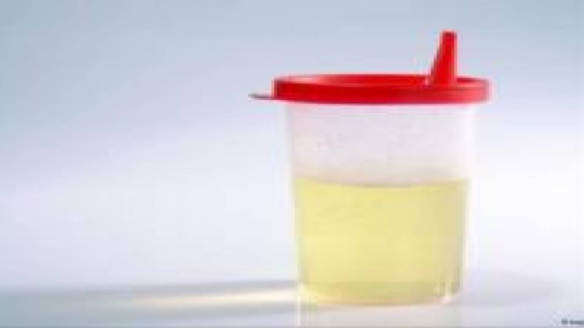 احذر من إهمال هذه المؤشرات في البول