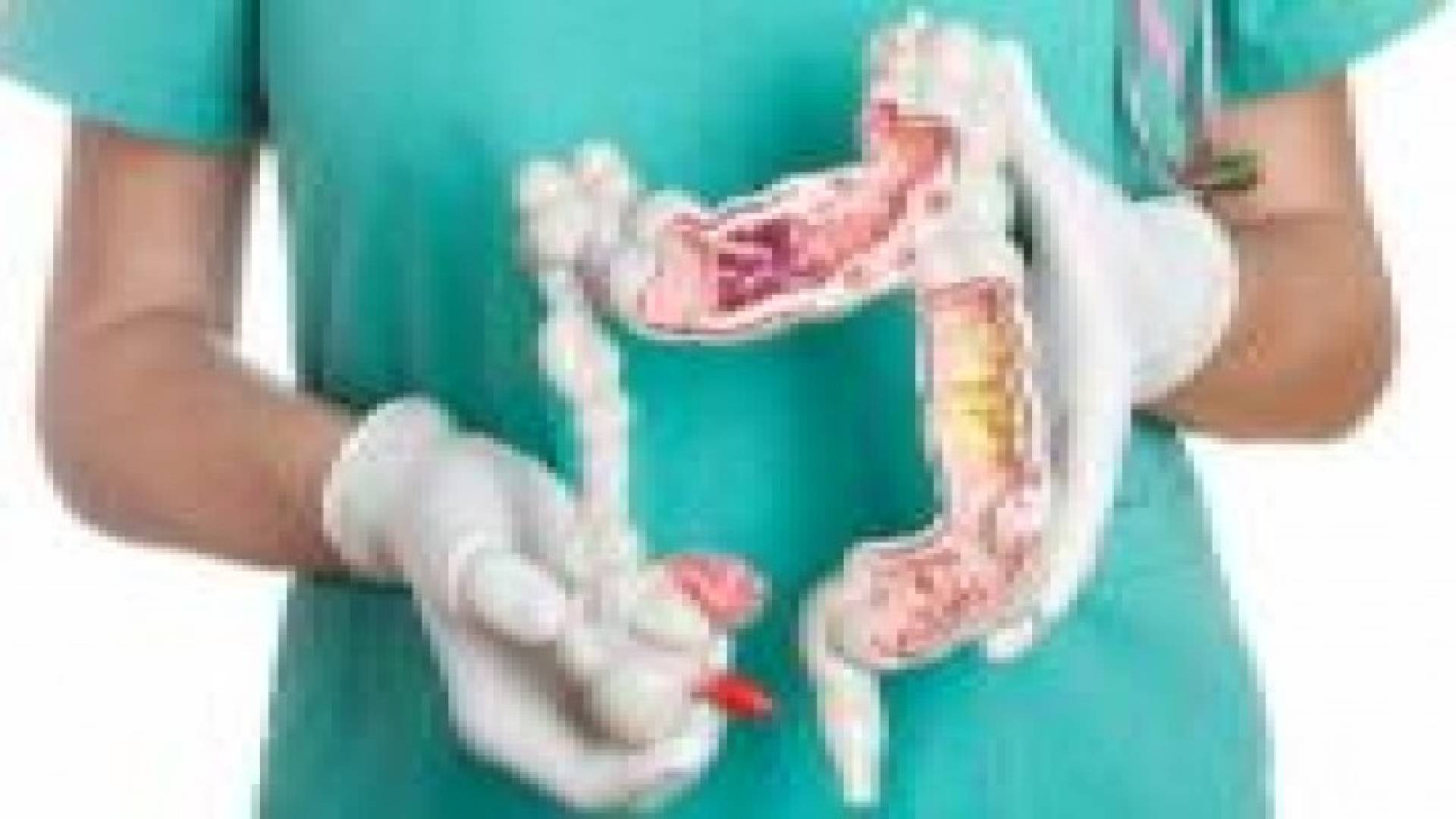 سرطان القولون يهاجم الأشخاص الأصغر سنا أيضا