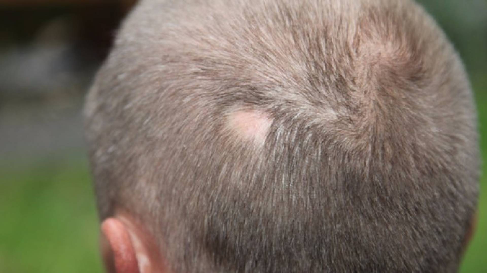 الثعلبة.. عندما يهاجم جهاز المناعة الشعر‬