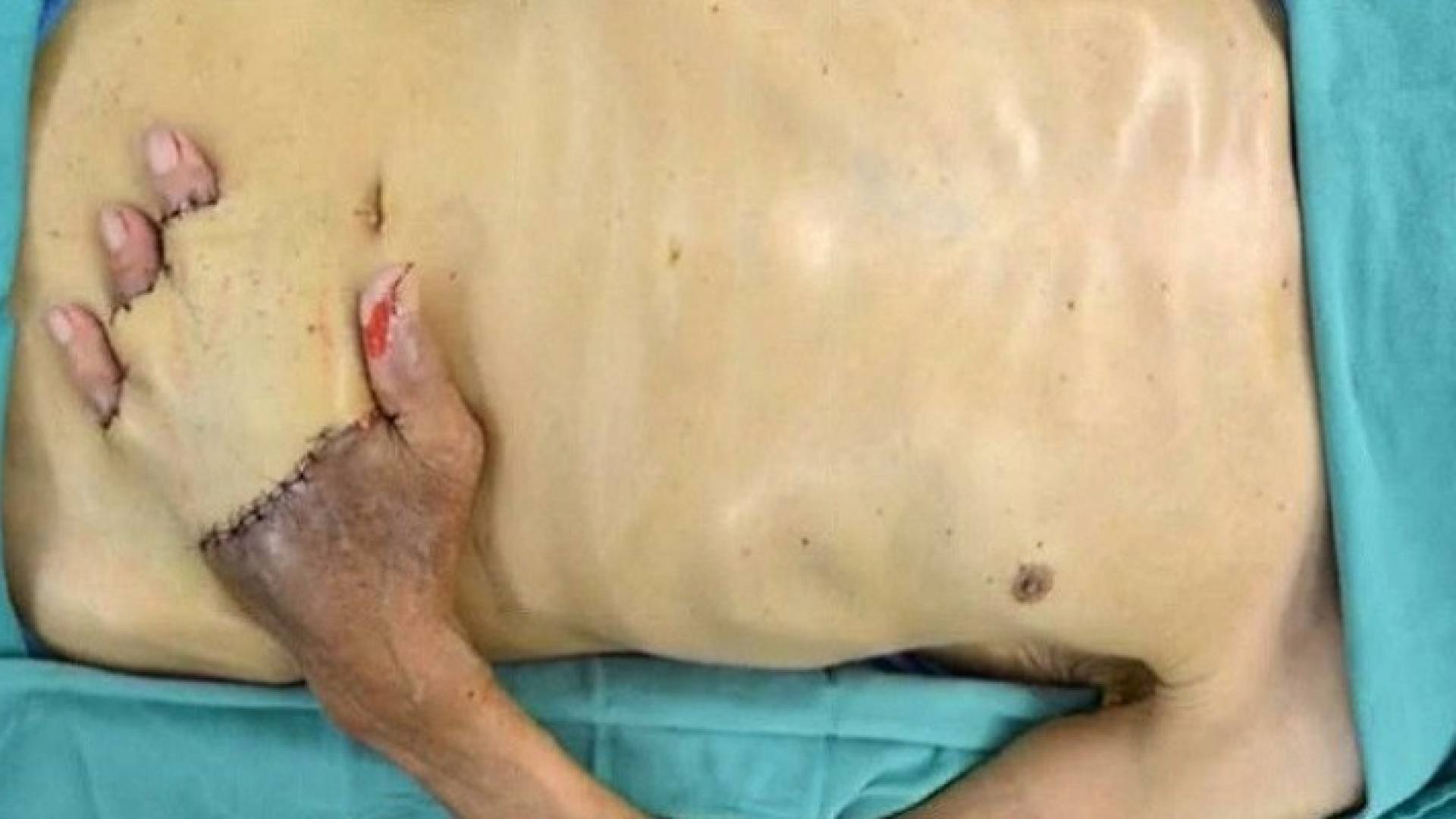 عملية جراحية غريبة تنقذ يد أمريكي من البتر