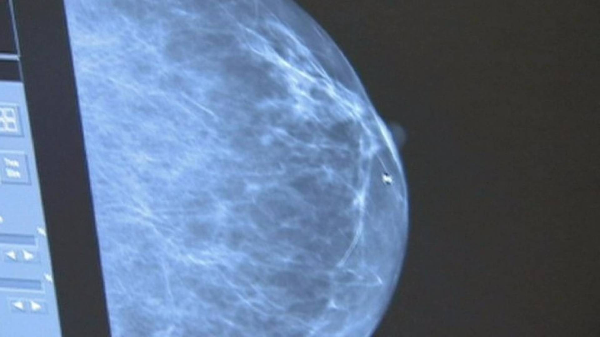 عقاقير تحمل أملا جديدا للمصابات بسرطان الثدي