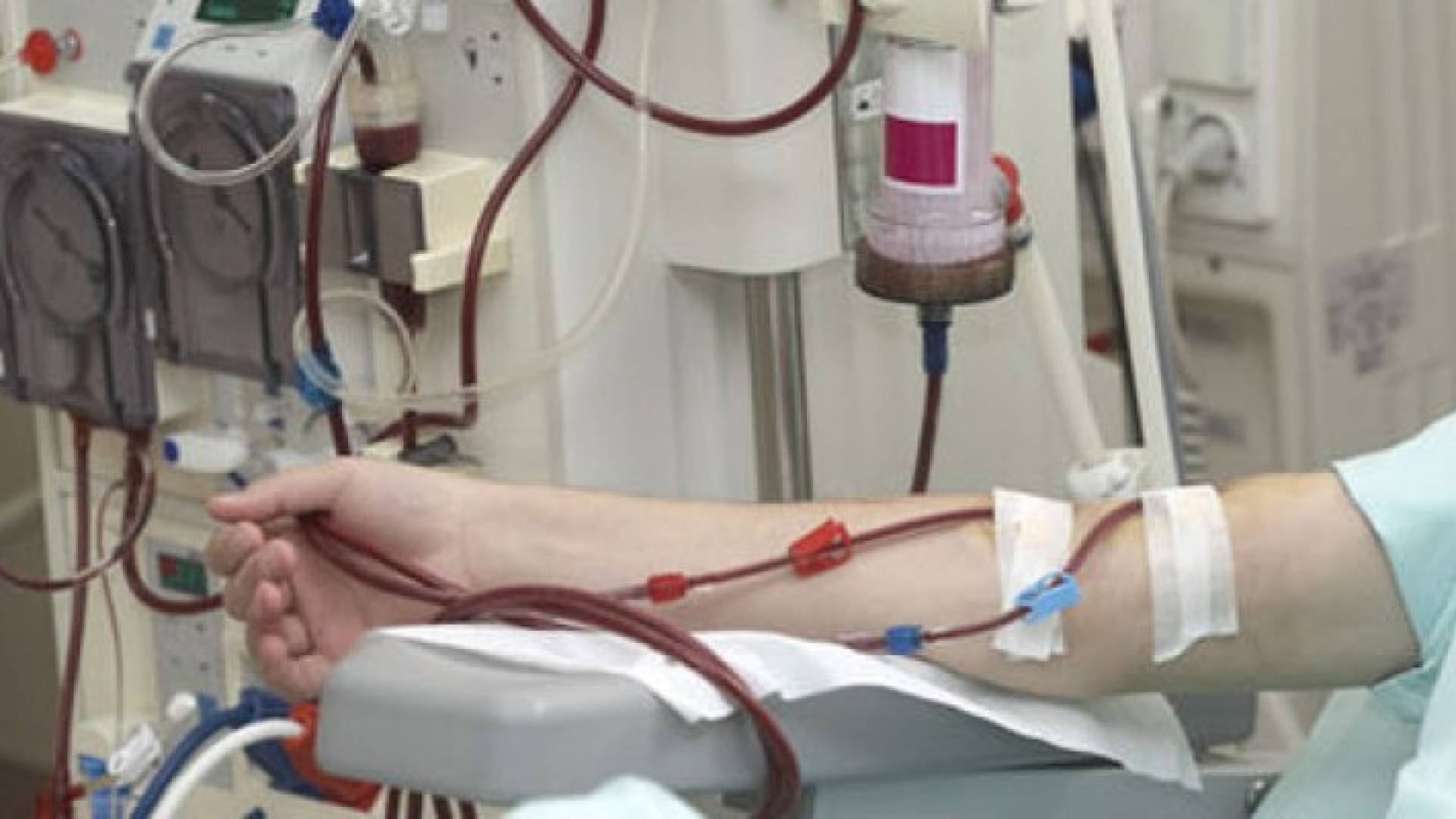 وداعا لغسيل الكلى : تكنولوجيا النانو فلتر كلي صناعية تحاكي البشرية